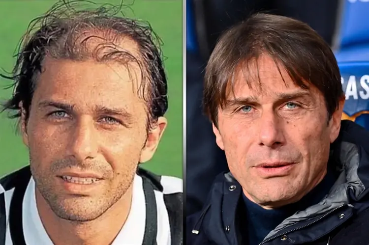 Antonio Conte Haartransplantation: Vorher und Nachher