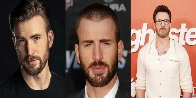 Chris Evans Hair Transplant: Before and After