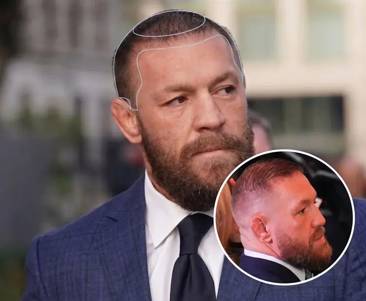 Conor McGregor Haartransplantation Vorher-Nachher-Ergebnisse in einer Elite-Klinik