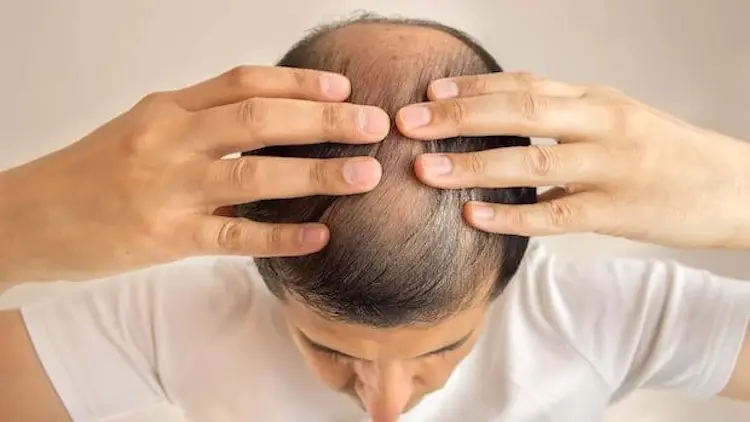 Finasteride Nedir? Finasteride Ne İşe Yarar?