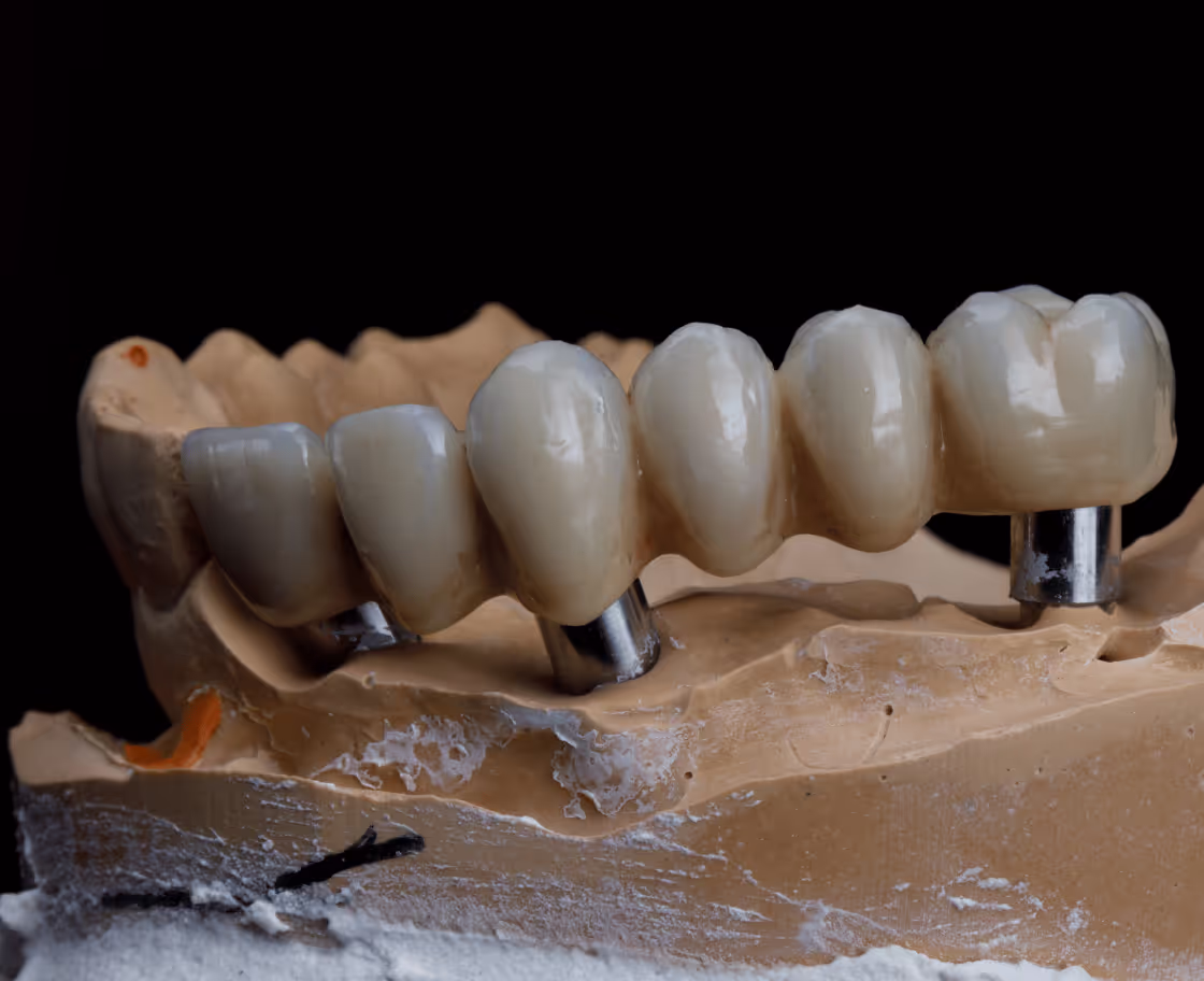 Expected Results & Benefits of All on 6 Dental Implants Surgery