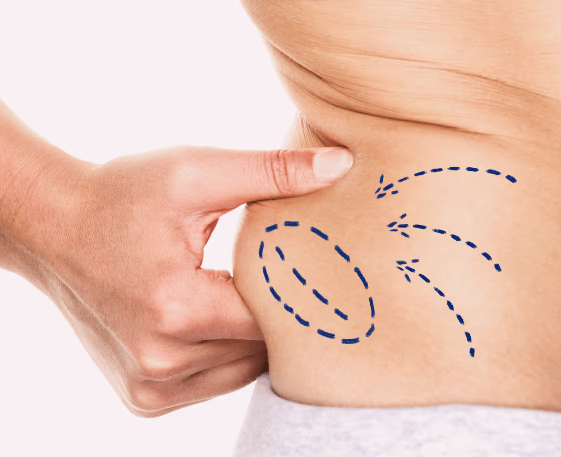 Expected Results & Benefits of Liposuction