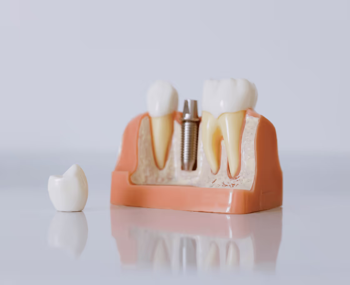 How Does All on 4 Dental Implants Surgery Work?