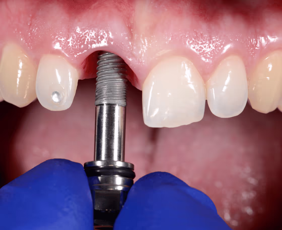 How Does Dental Implant Surgery Work?