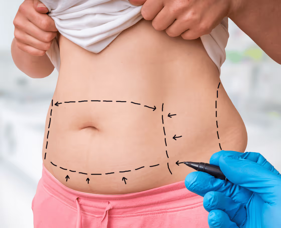 How Does Liposuction Work?