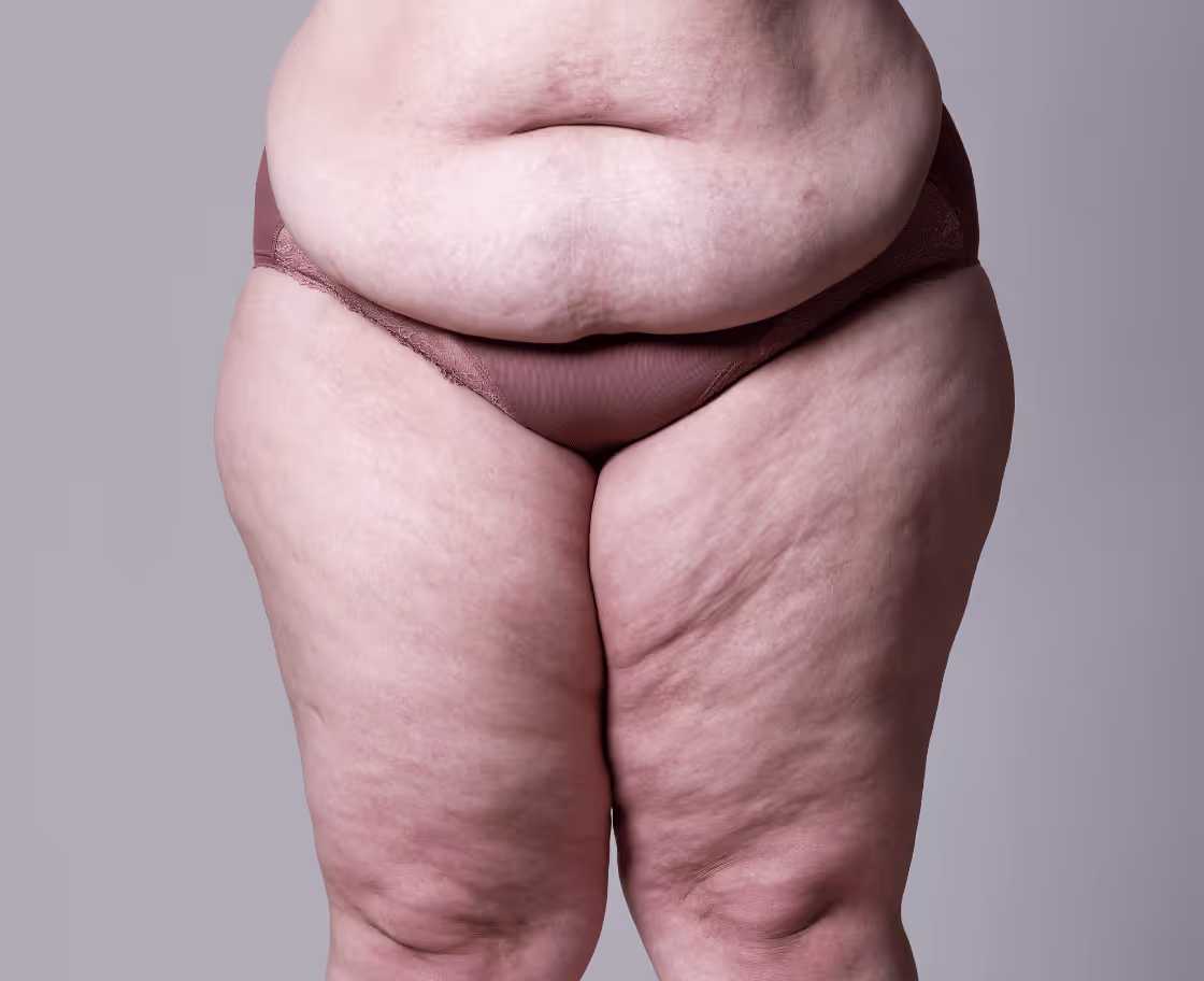 Uyluk Germe Ameliyatı Nedir?