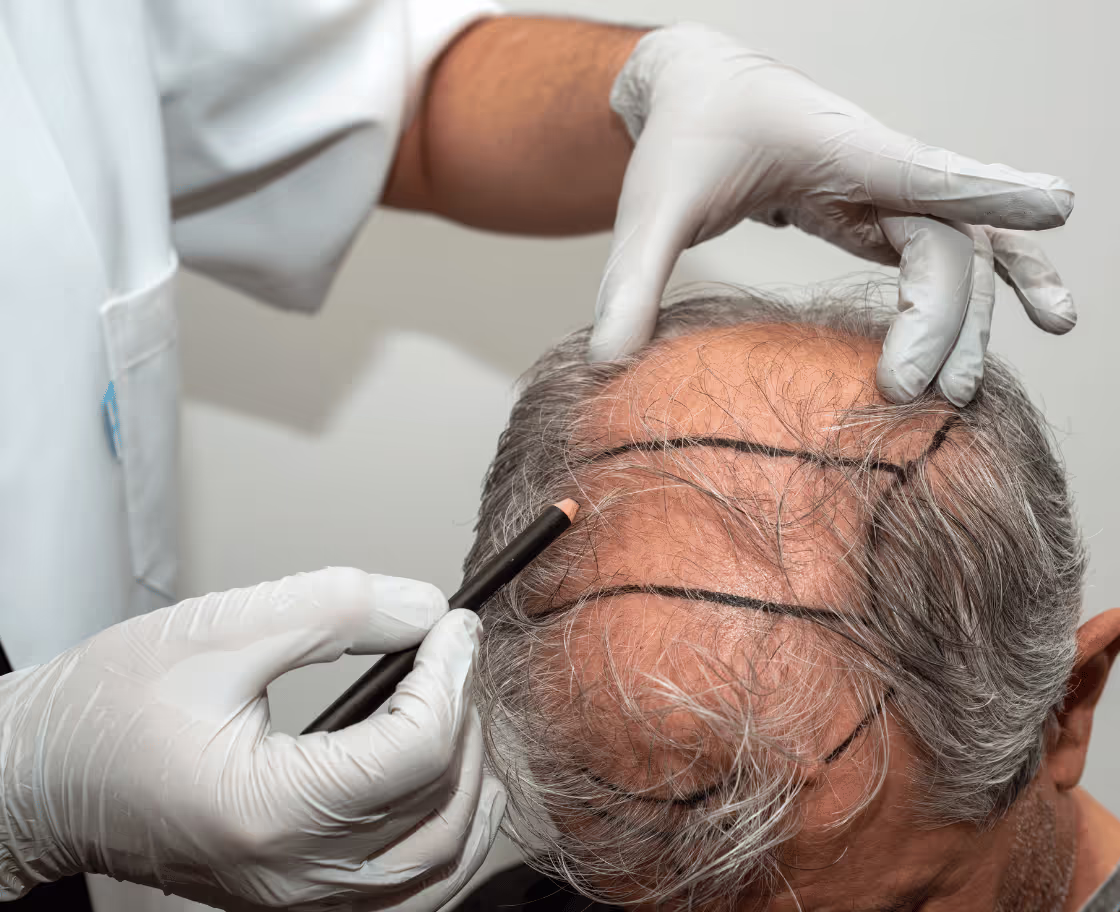 Wer kann von einer FUE-Haartransplantation profitieren?