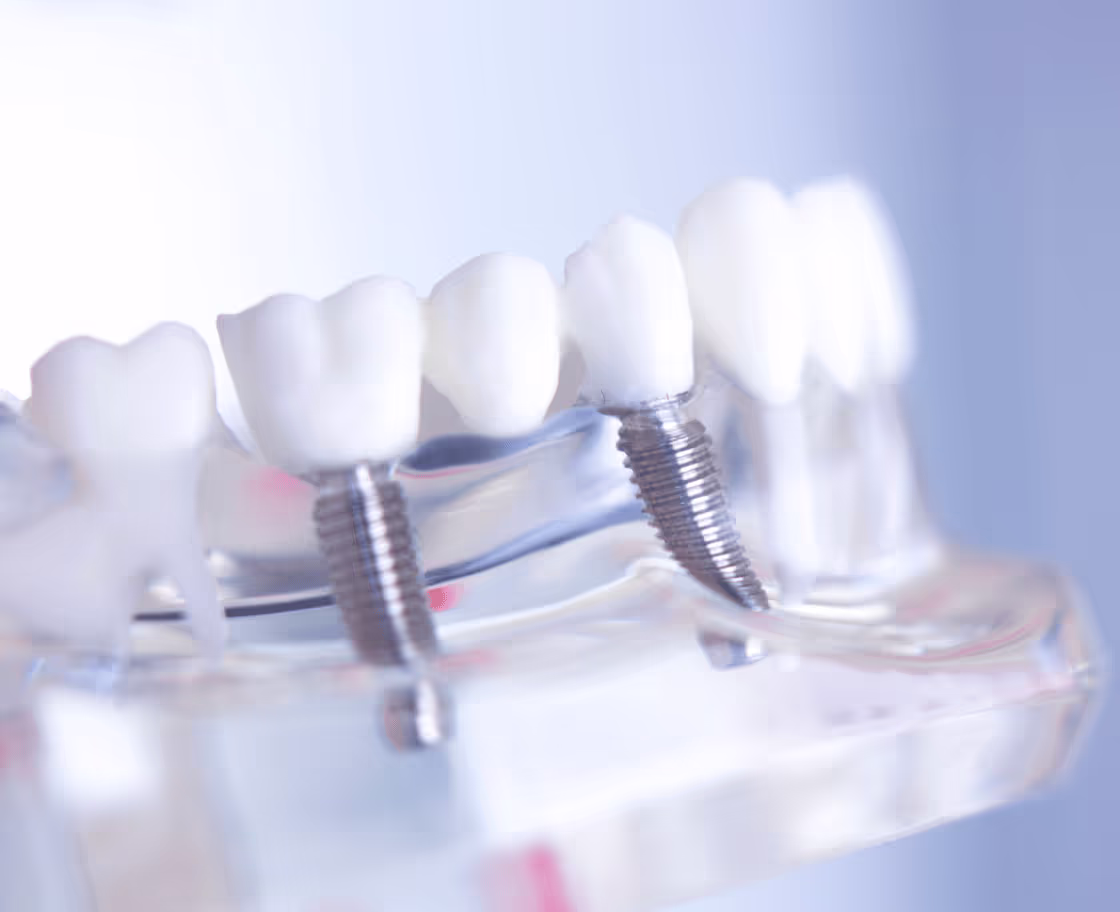 What is All on 4 Dental Implants Surgery?