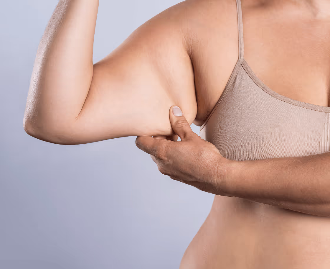 What is arm lift surgery?