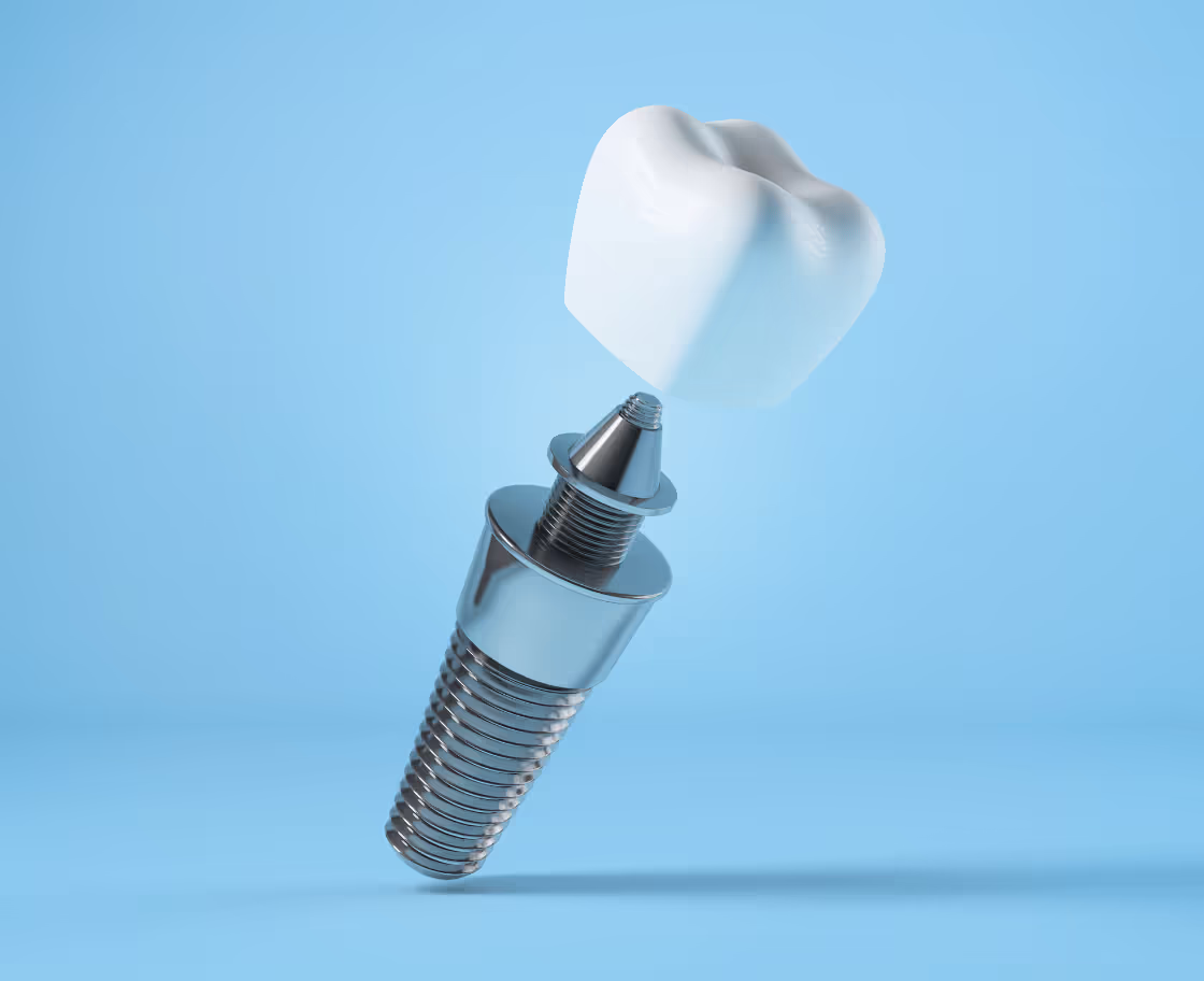 Who Can Benefit from All on 6 Dental Implants Surgery?