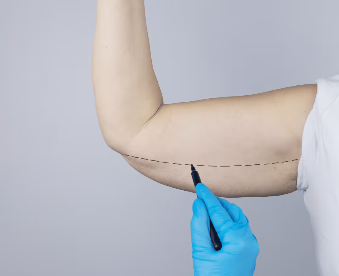Who can benefit from arm lift surgery?