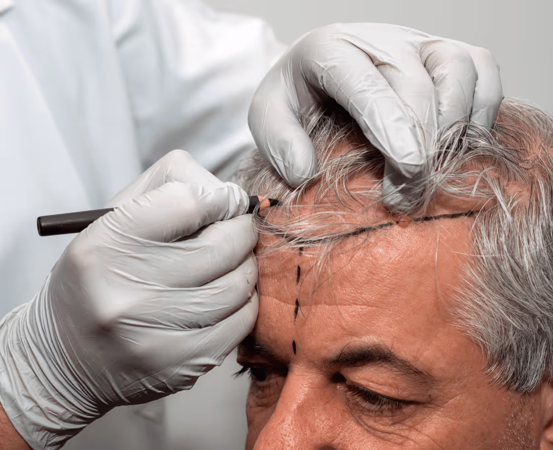 Wie läuft eine DHI-Haartransplantation ab?