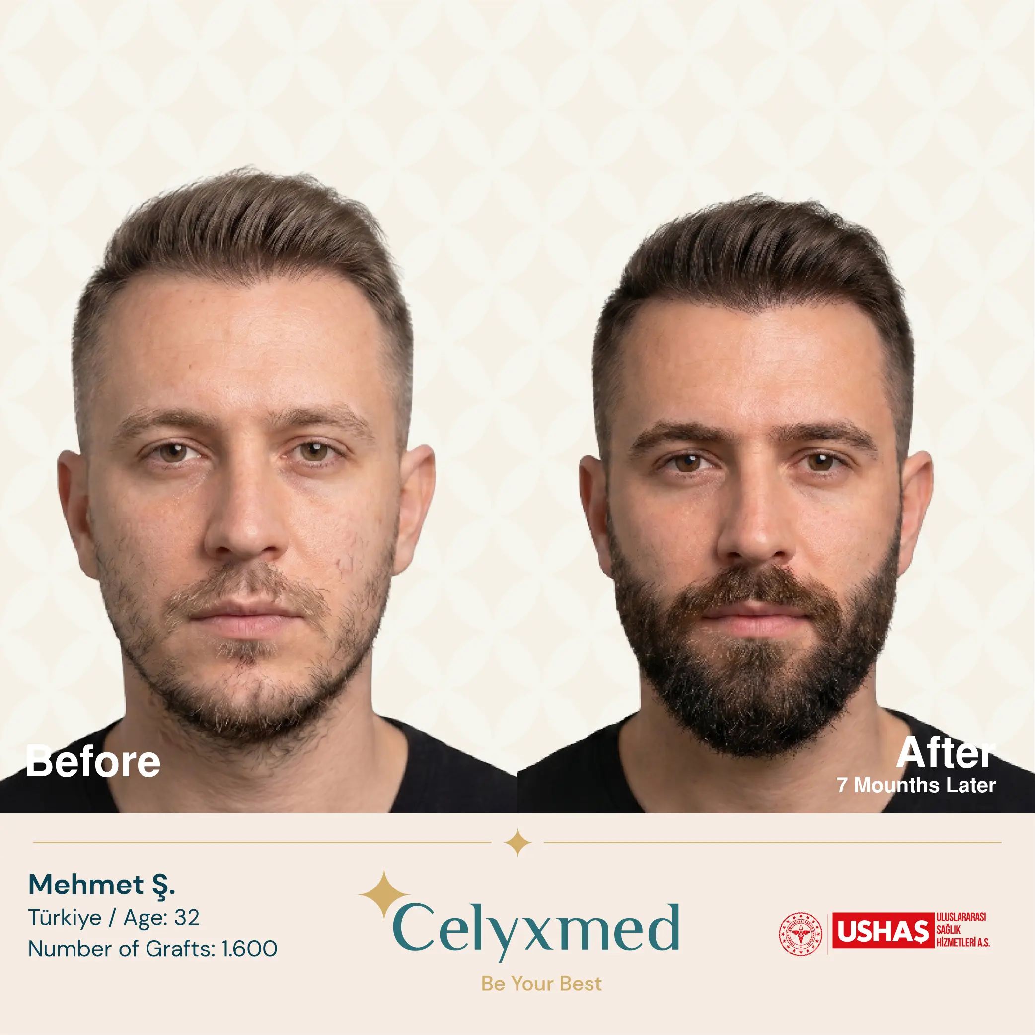 Beard Transplant in Turkey