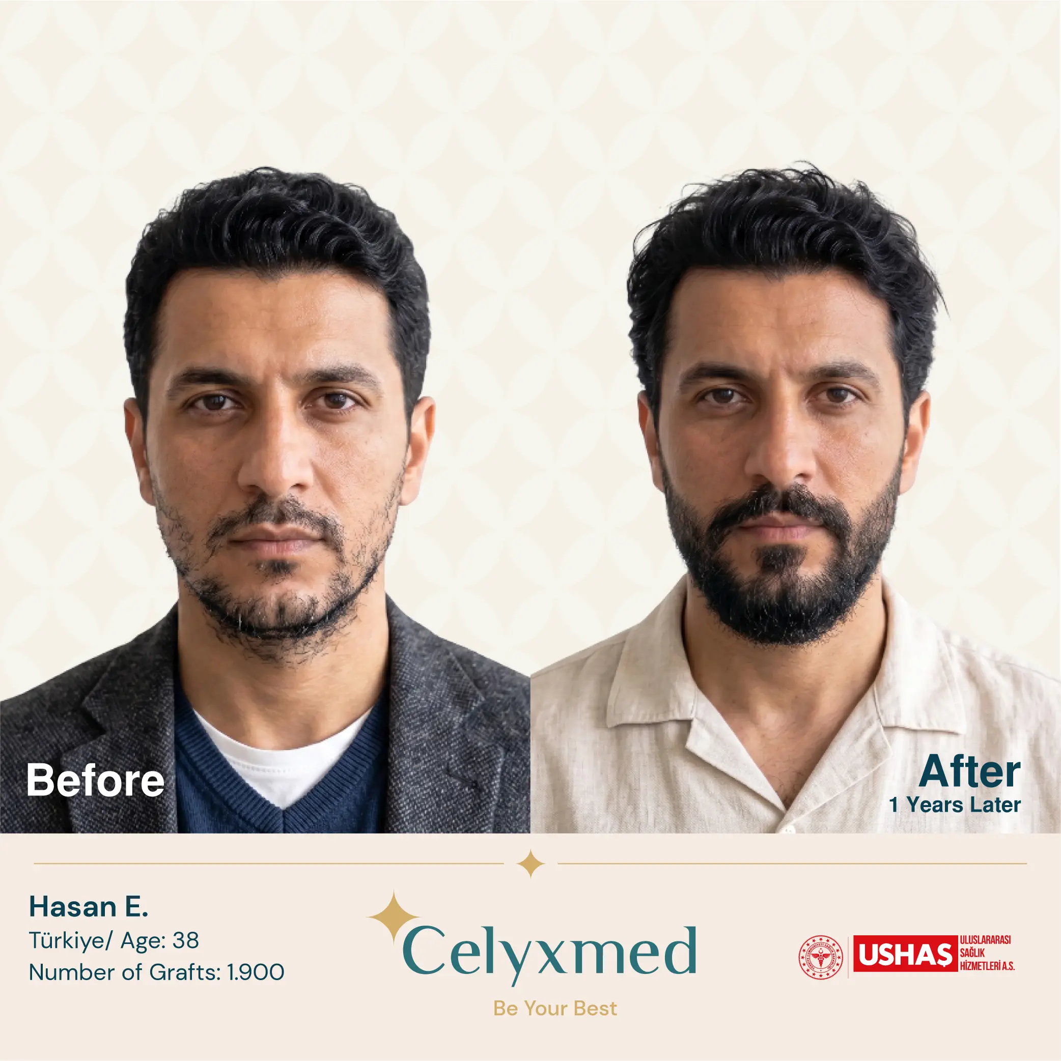 Barttransplantation in der Türkei