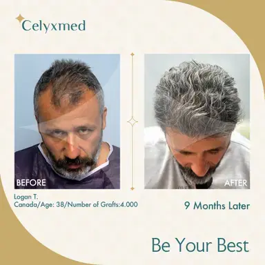 FUE-Haartransplantation in der Türkei