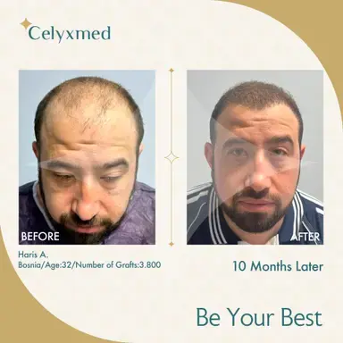 FUE-Haartransplantation in der Türkei