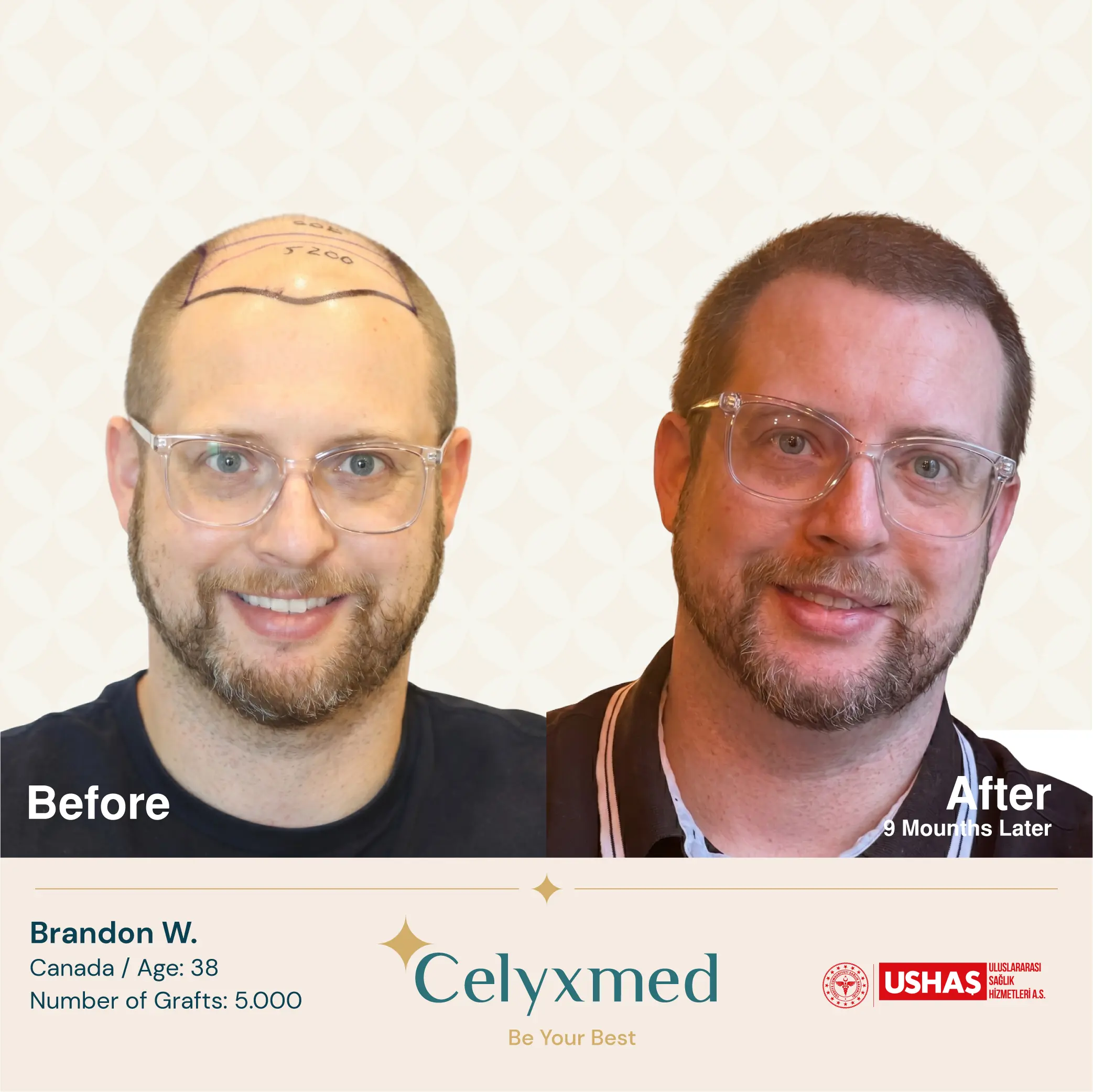 FUE-Haartransplantation in der Türkei