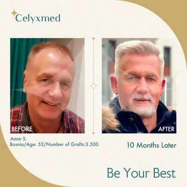 FUE-Haartransplantation in der Türkei