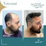 Hair Transplant in Turkey