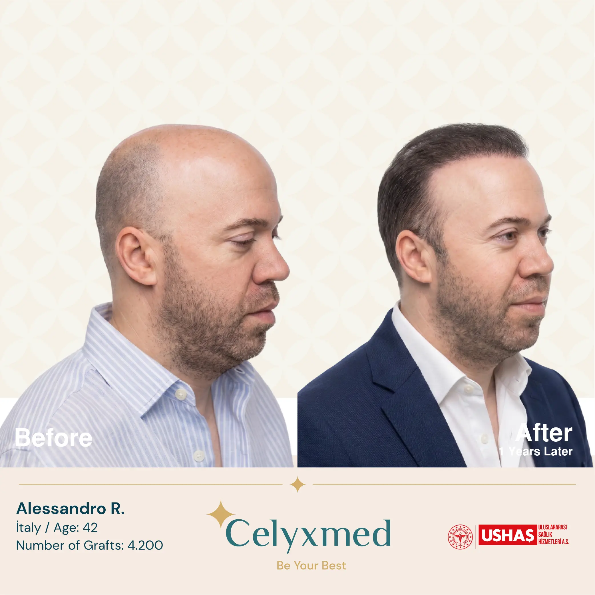 Hair Transplant in Turkey