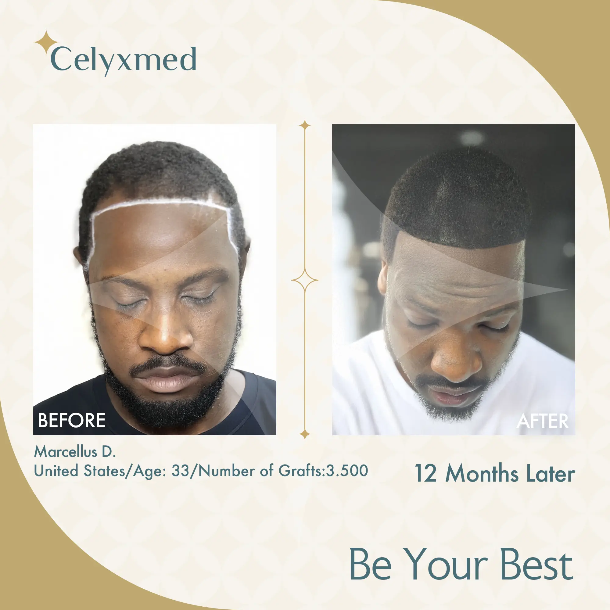 Afro-American Hair Transplant in Turkey