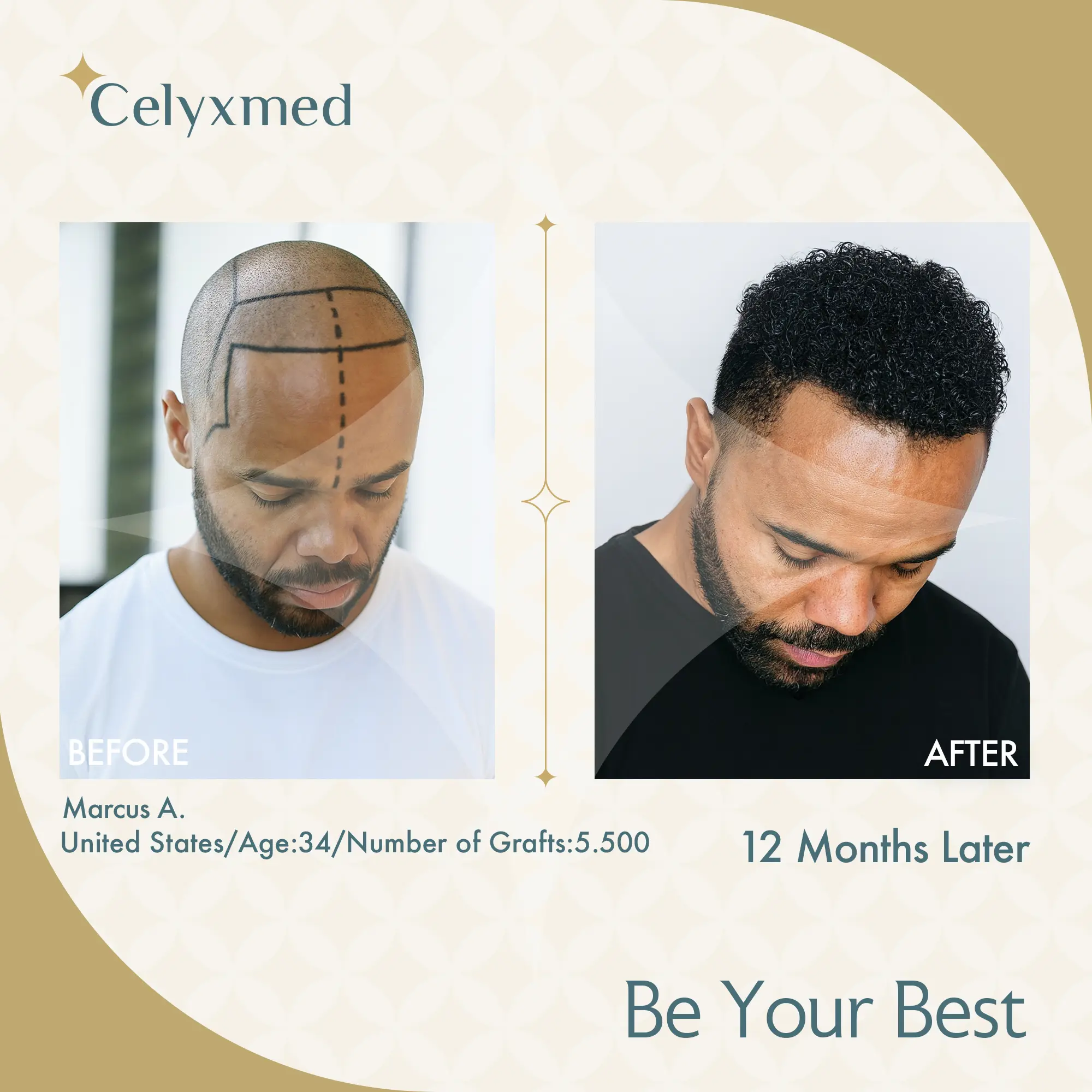 Afro-American Hair Transplant in Turkey