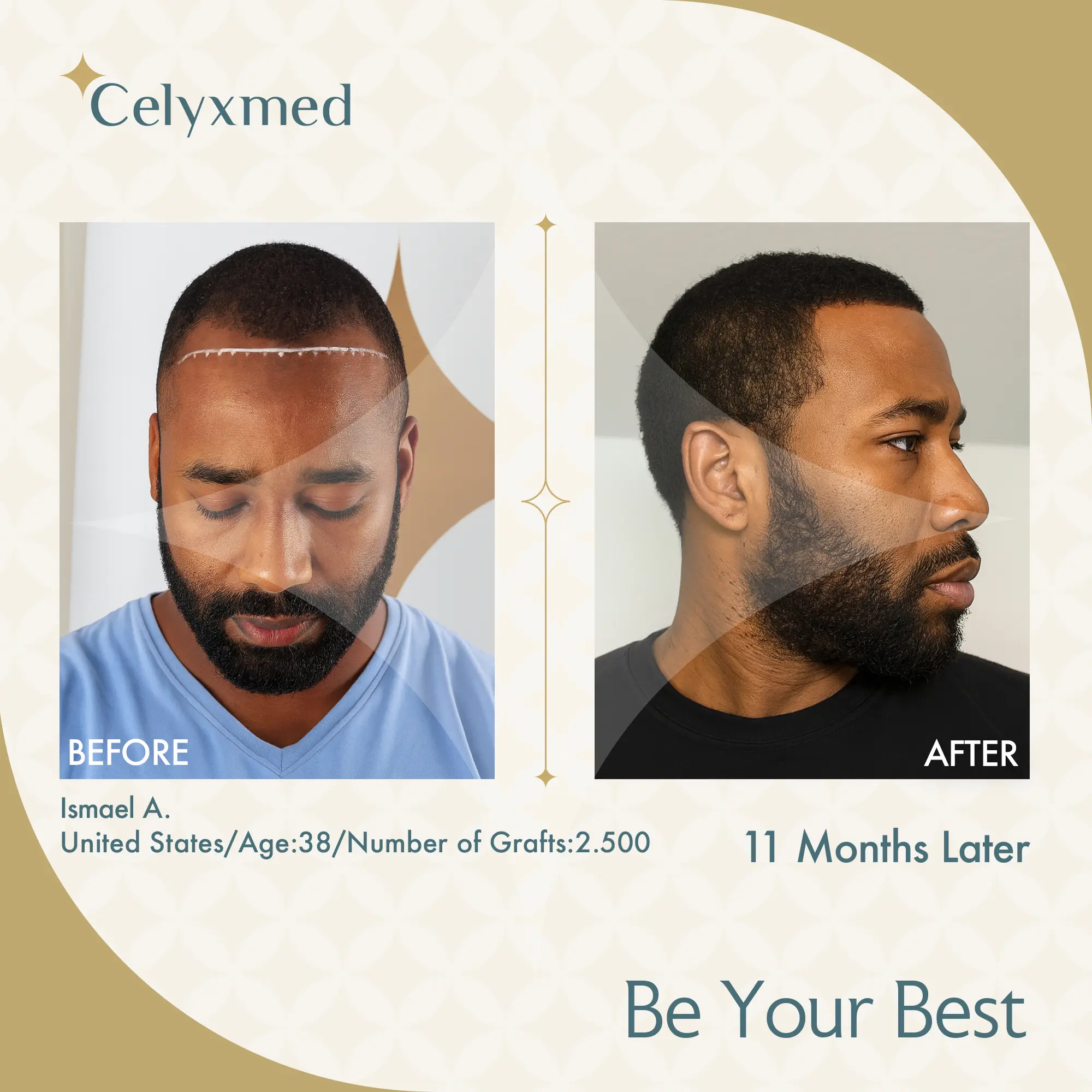 Afro-American Hair Transplant in Turkey