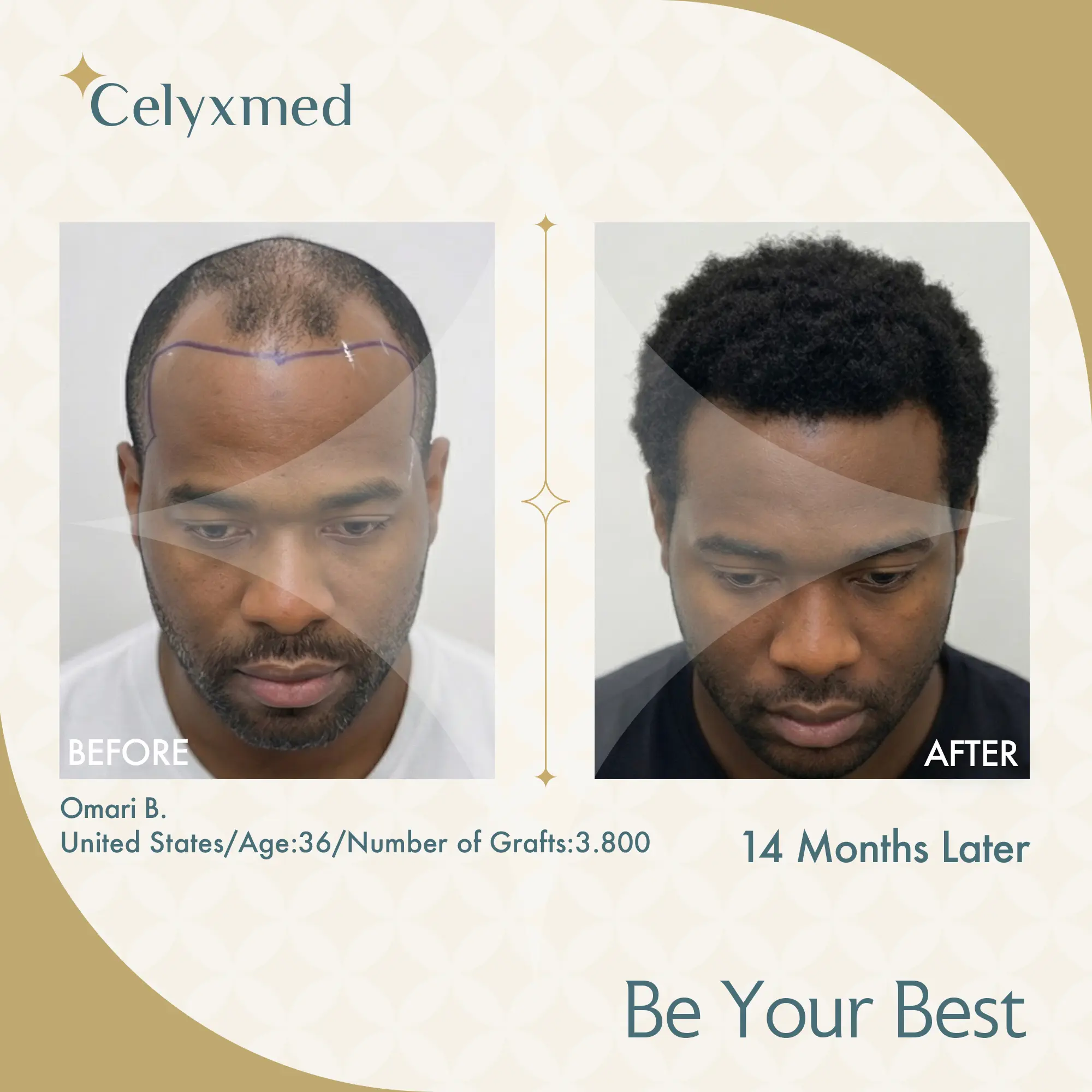Afro-American Hair Transplant in Turkey