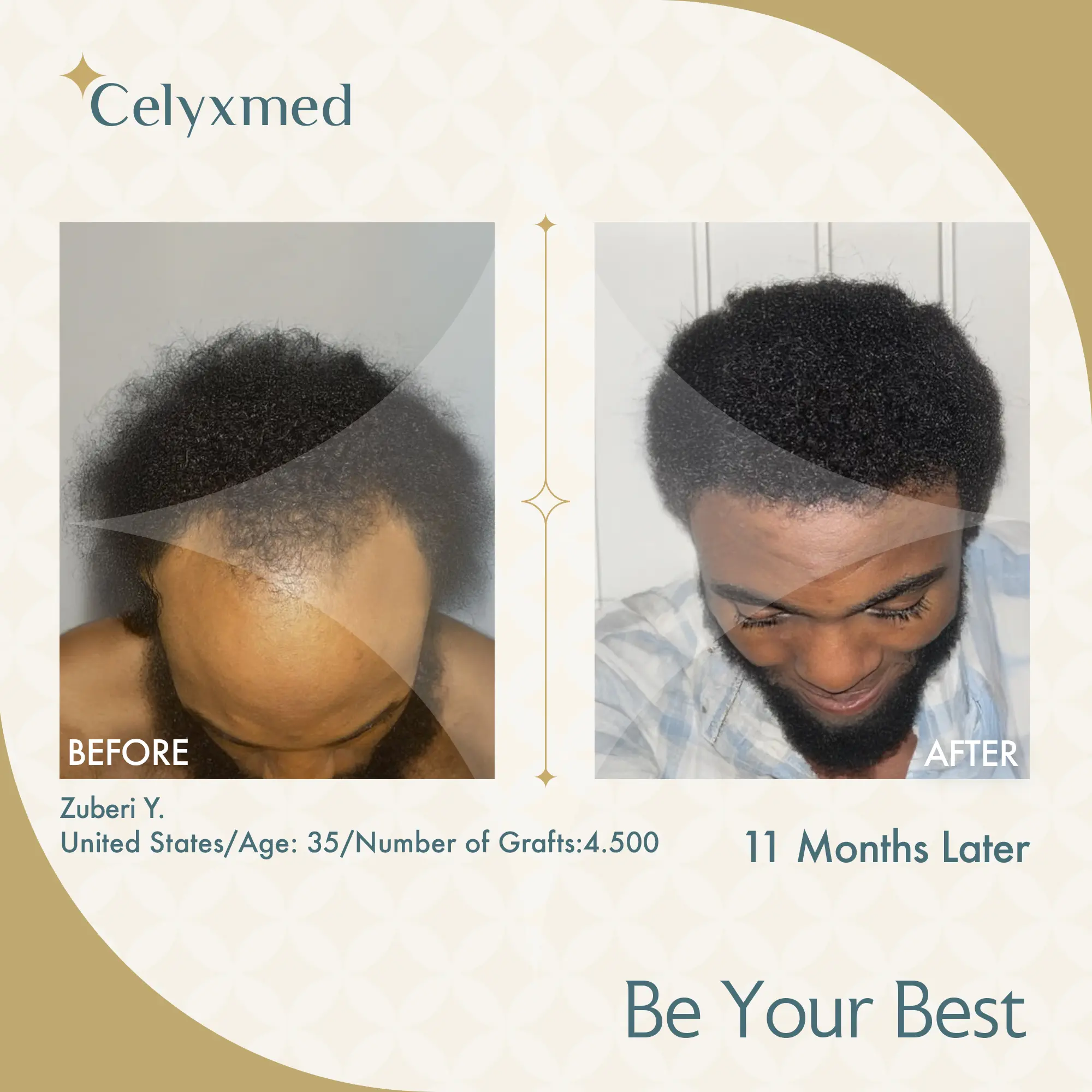 Afro-American Hair Transplant in Turkey