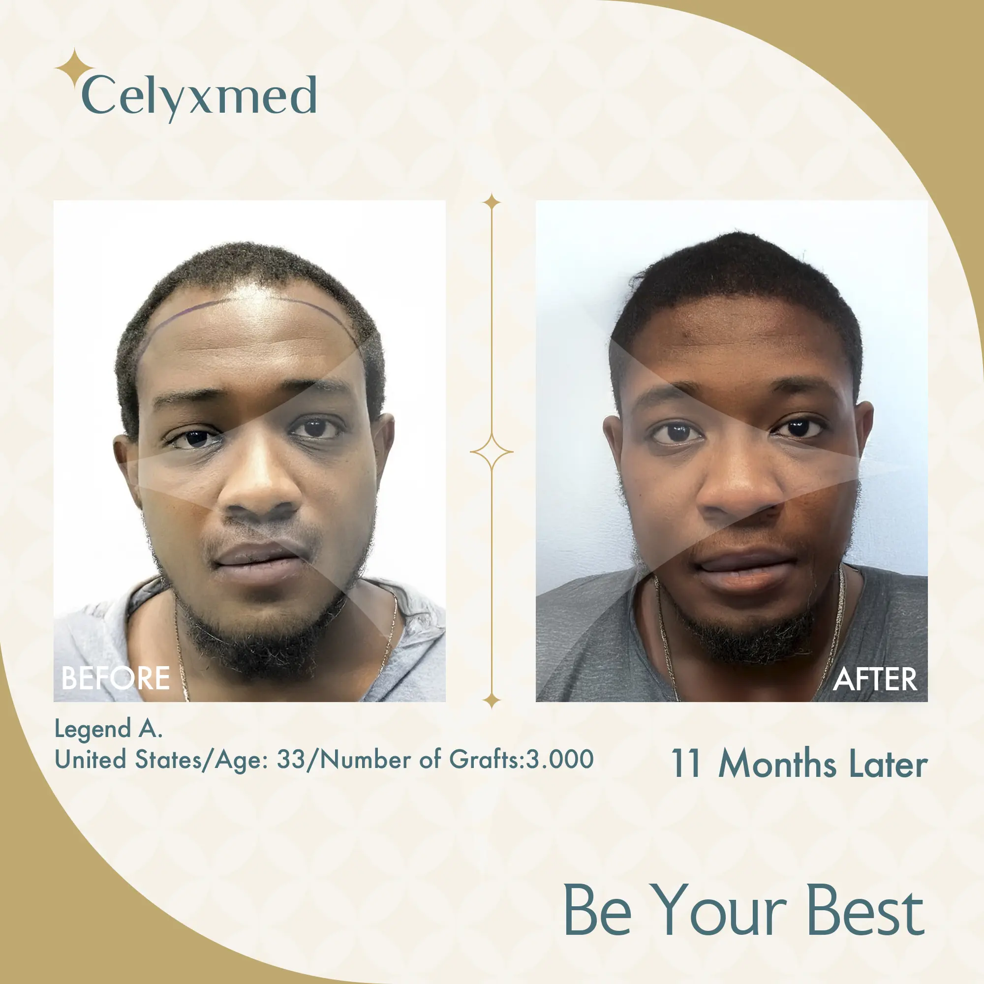 Afro-American Hair Transplant in Turkey