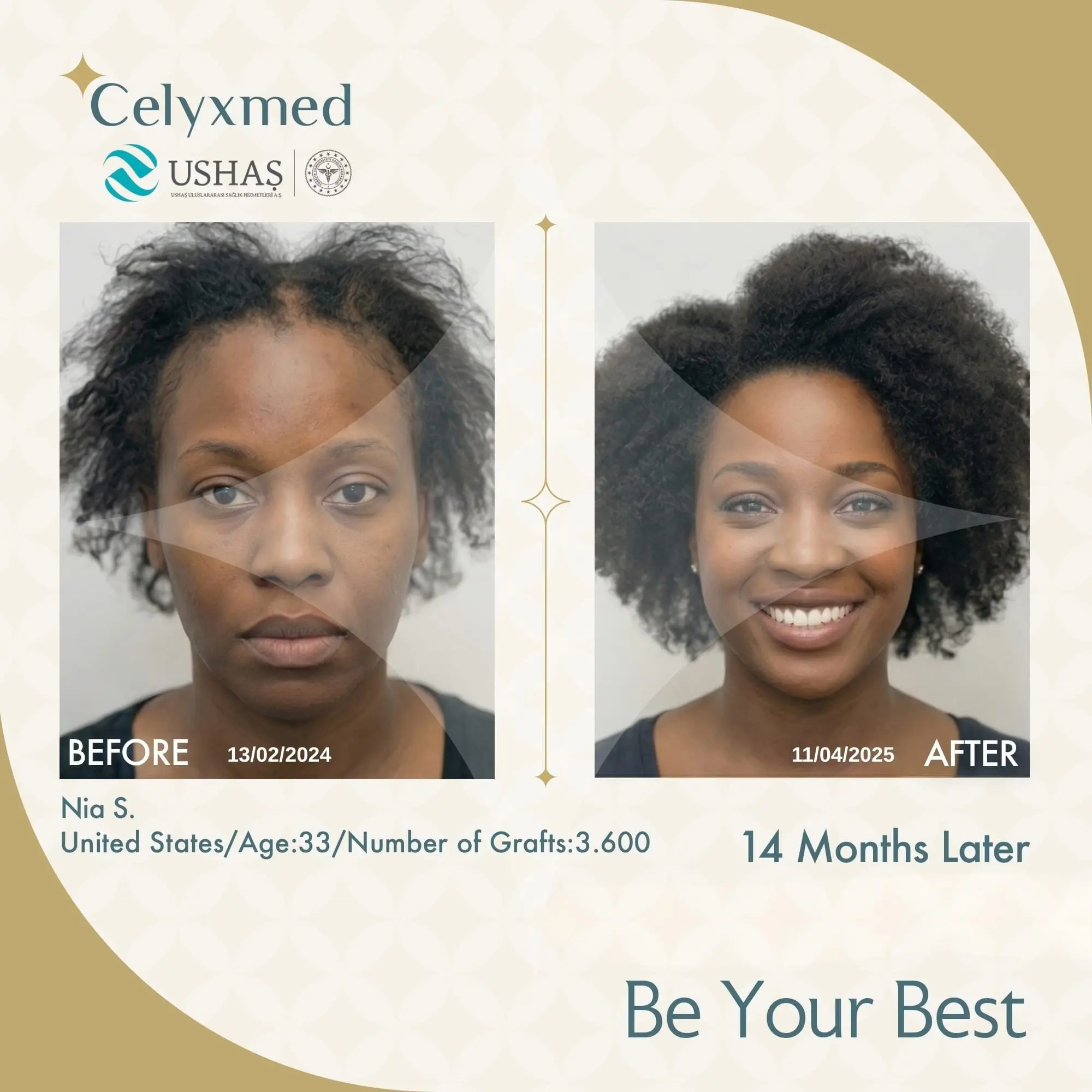 Afro-American Hair Transplant in Turkey