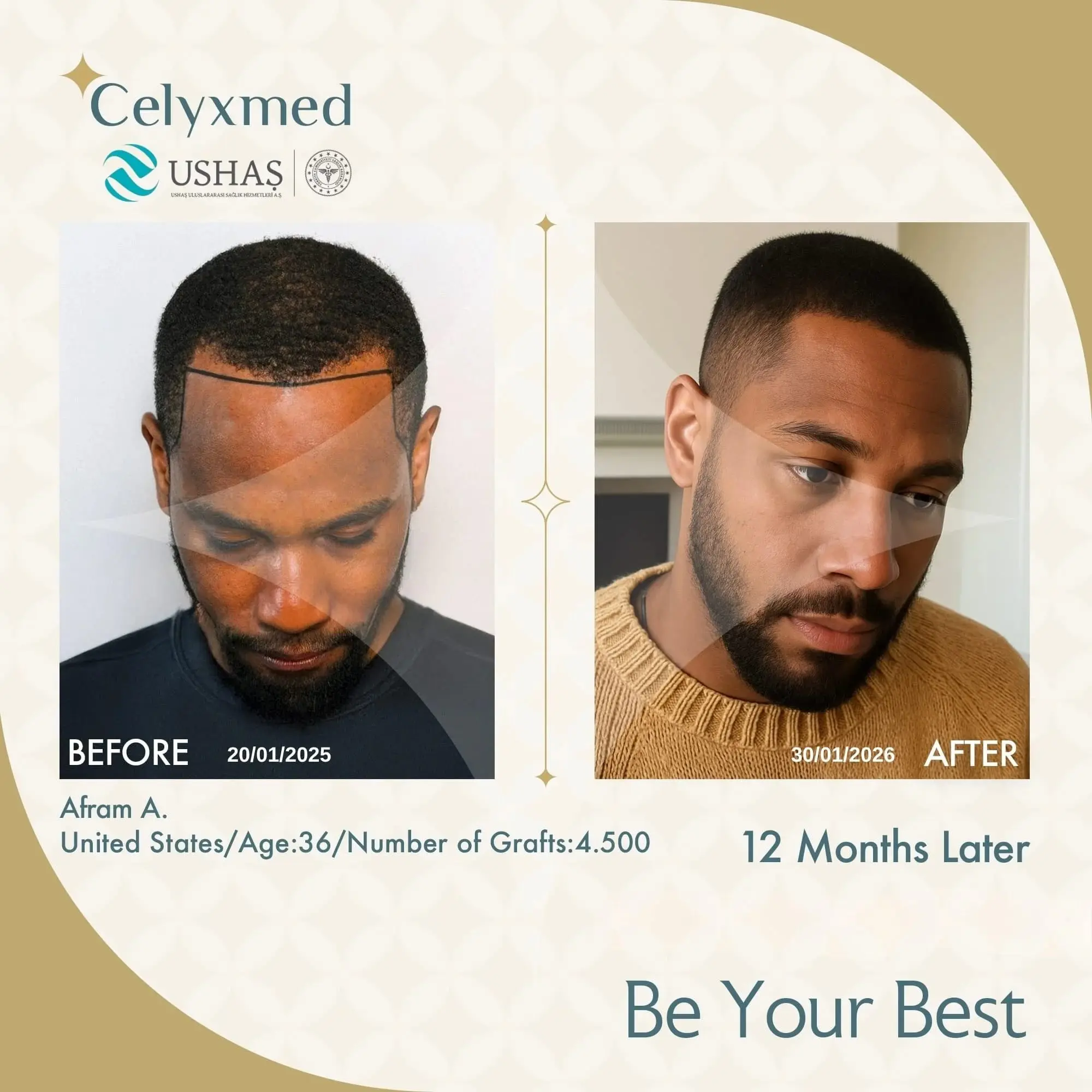Afro-American Hair Transplant in Turkey