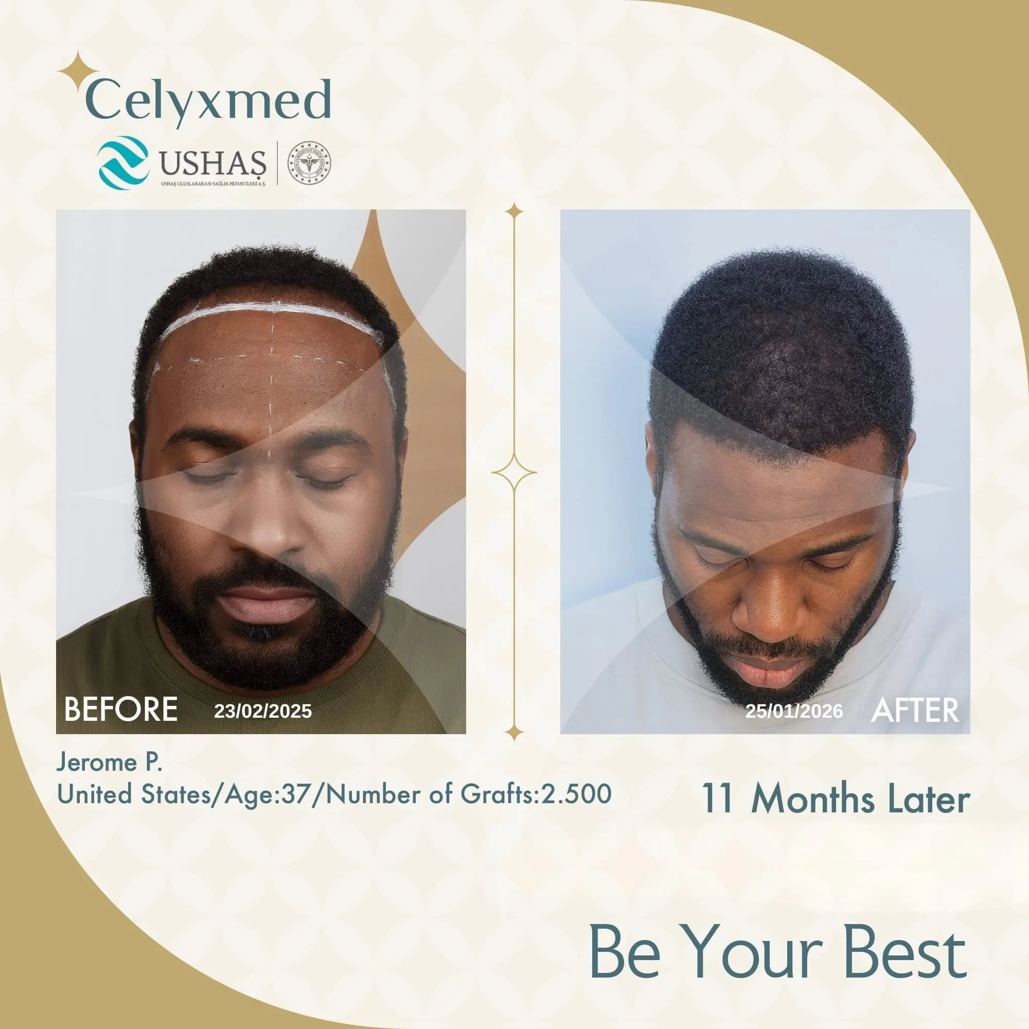 Afro-American Hair Transplant in Turkey