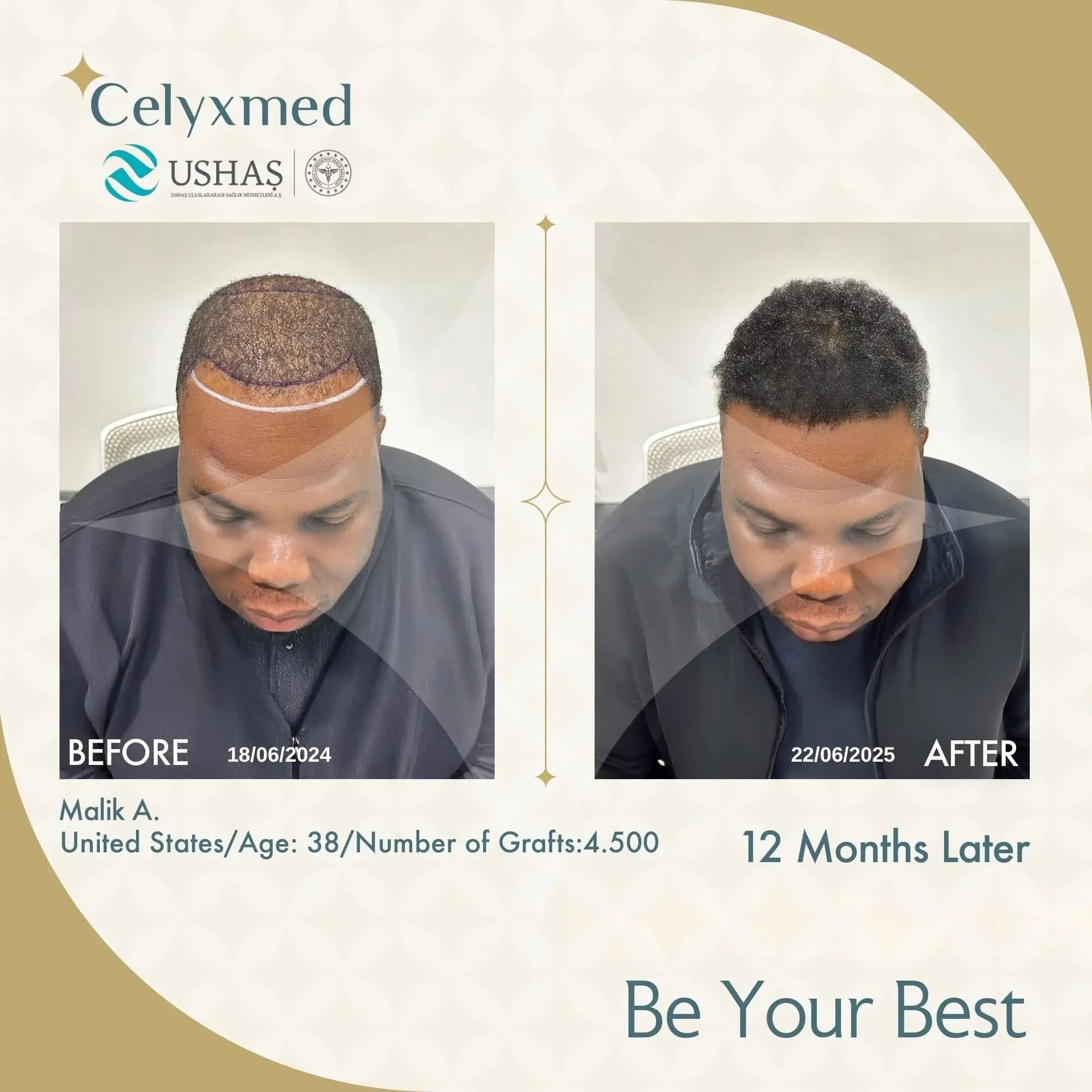 Afro-American Hair Transplant in Turkey