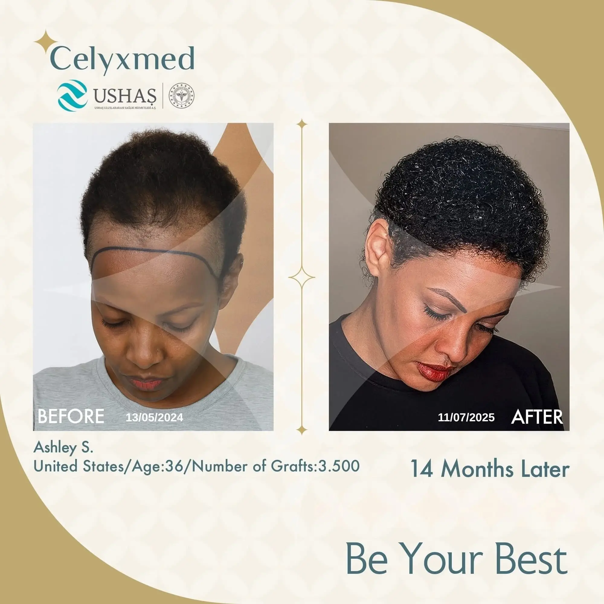 Afro-American Hair Transplant in Turkey