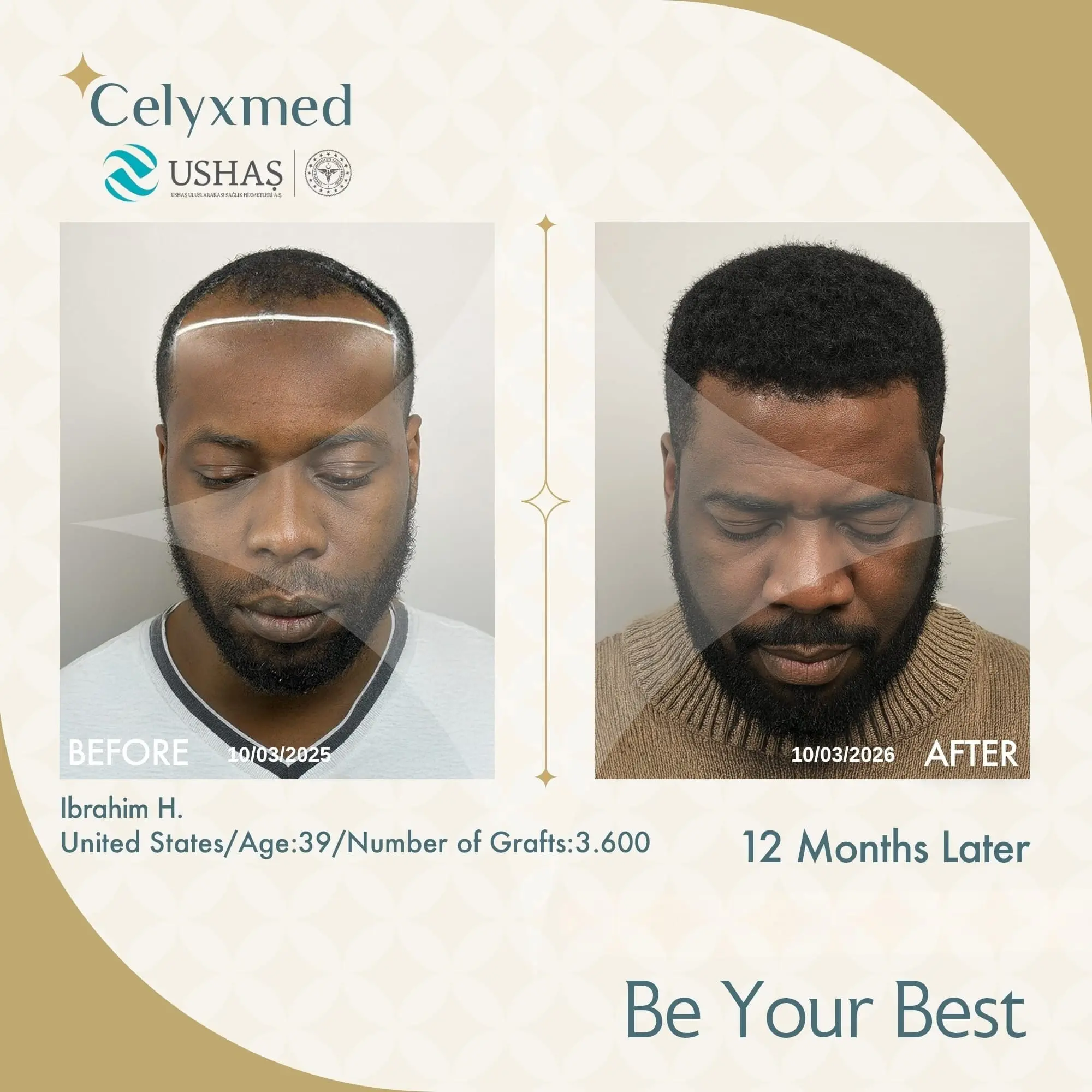 Afro-American Hair Transplant in Turkey