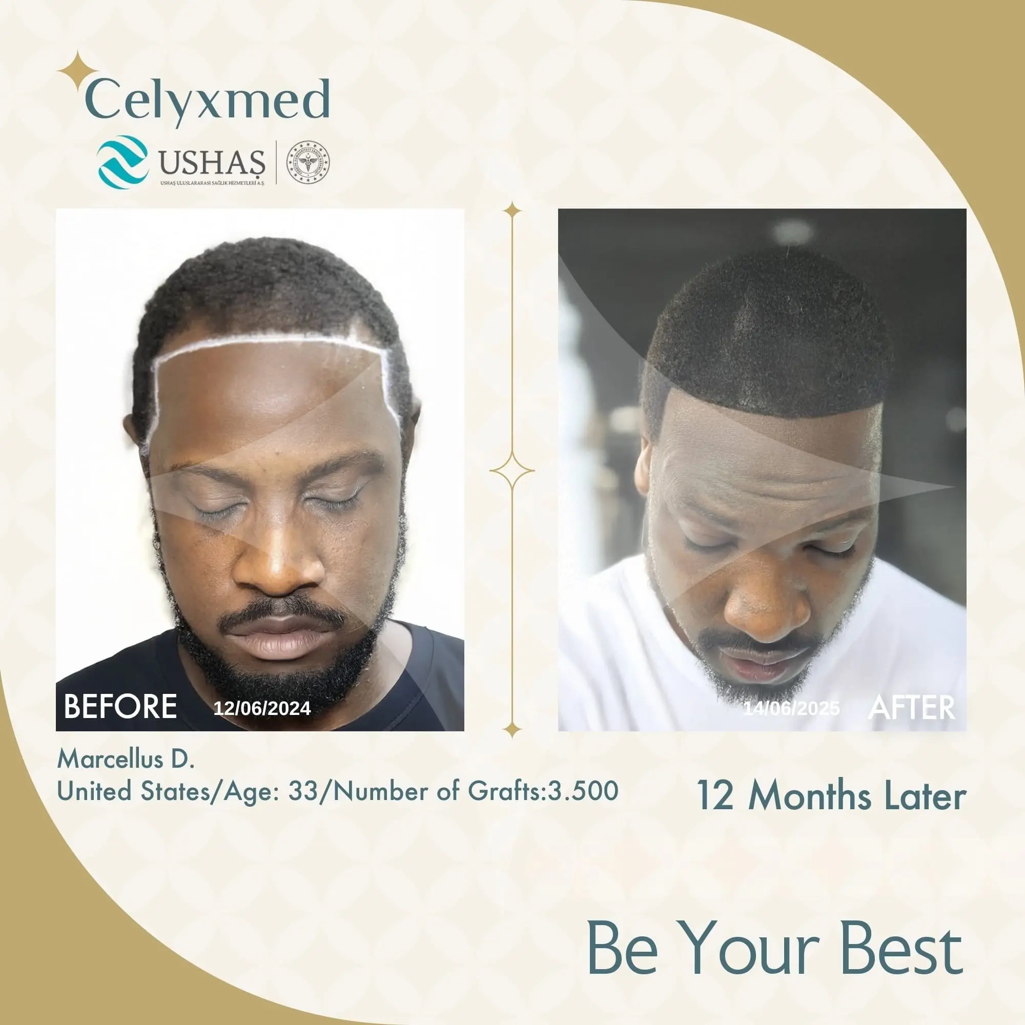 Afro-American Hair Transplant in Turkey