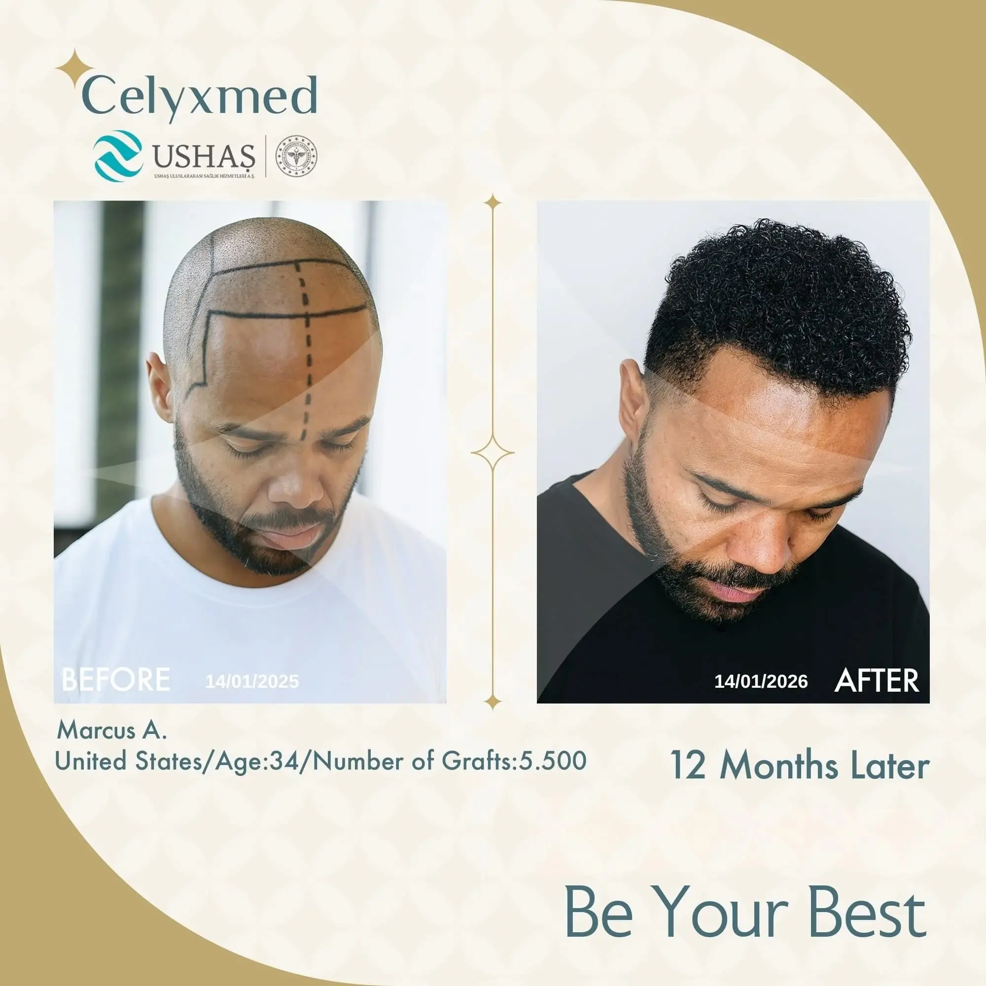 Afro-American Hair Transplant in Turkey