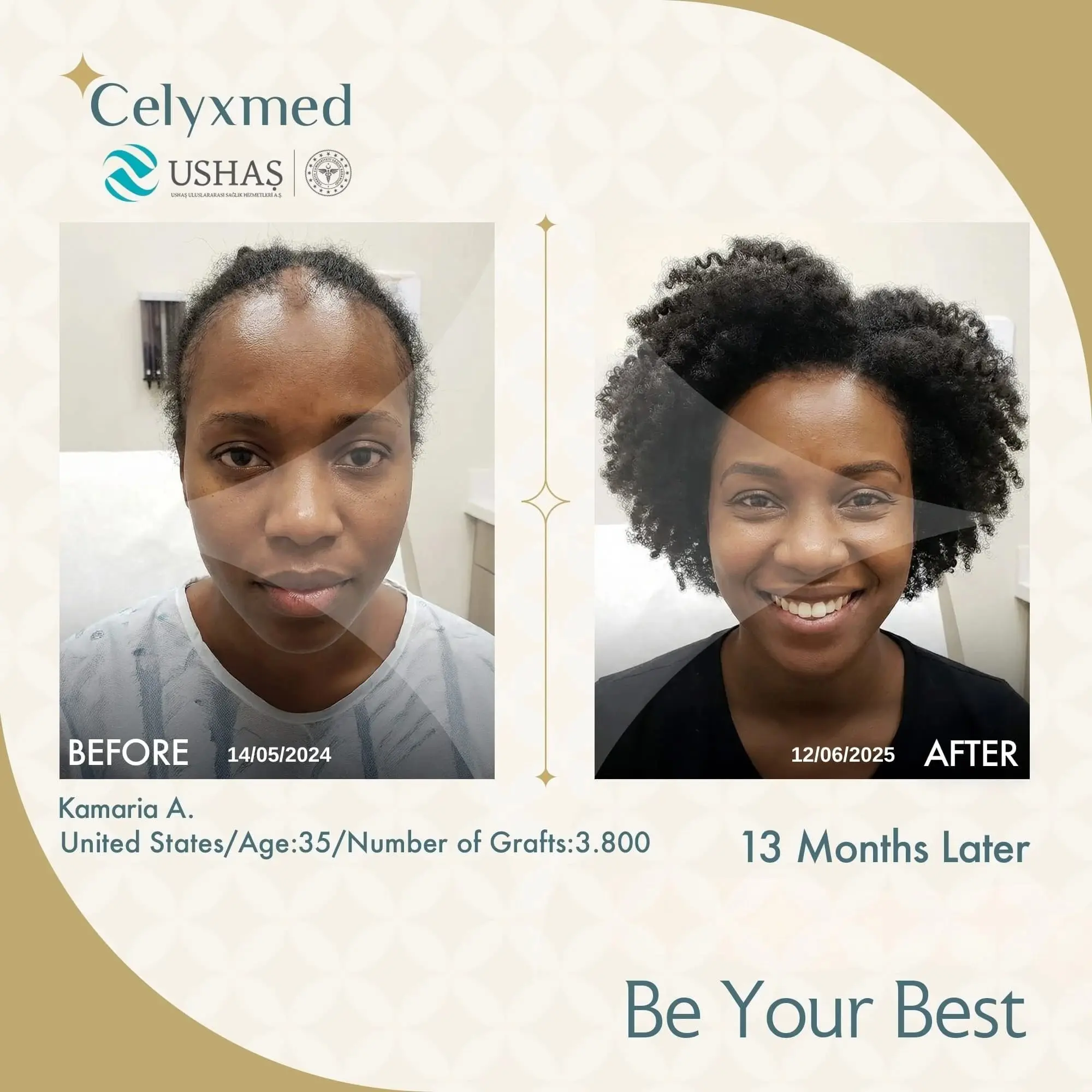 Afro-American Hair Transplant in Turkey