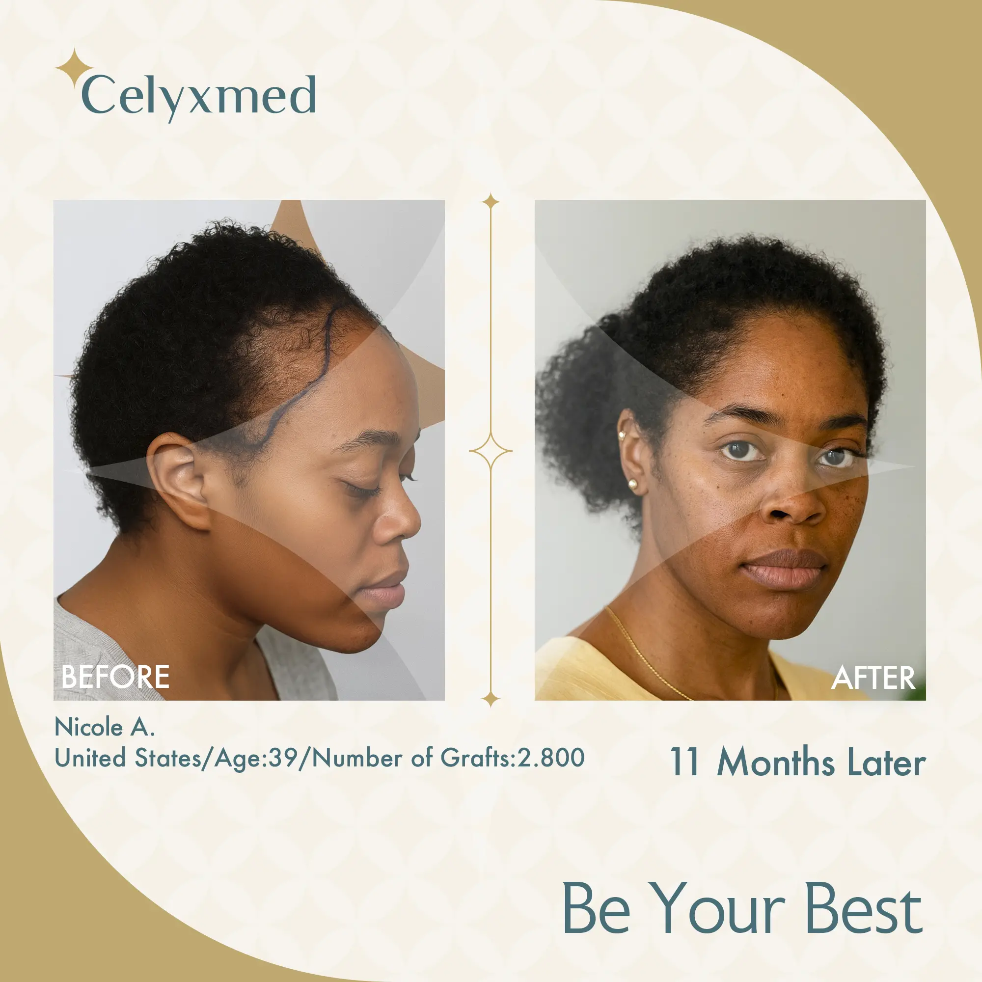 Afro Haartransplantation Türkei |