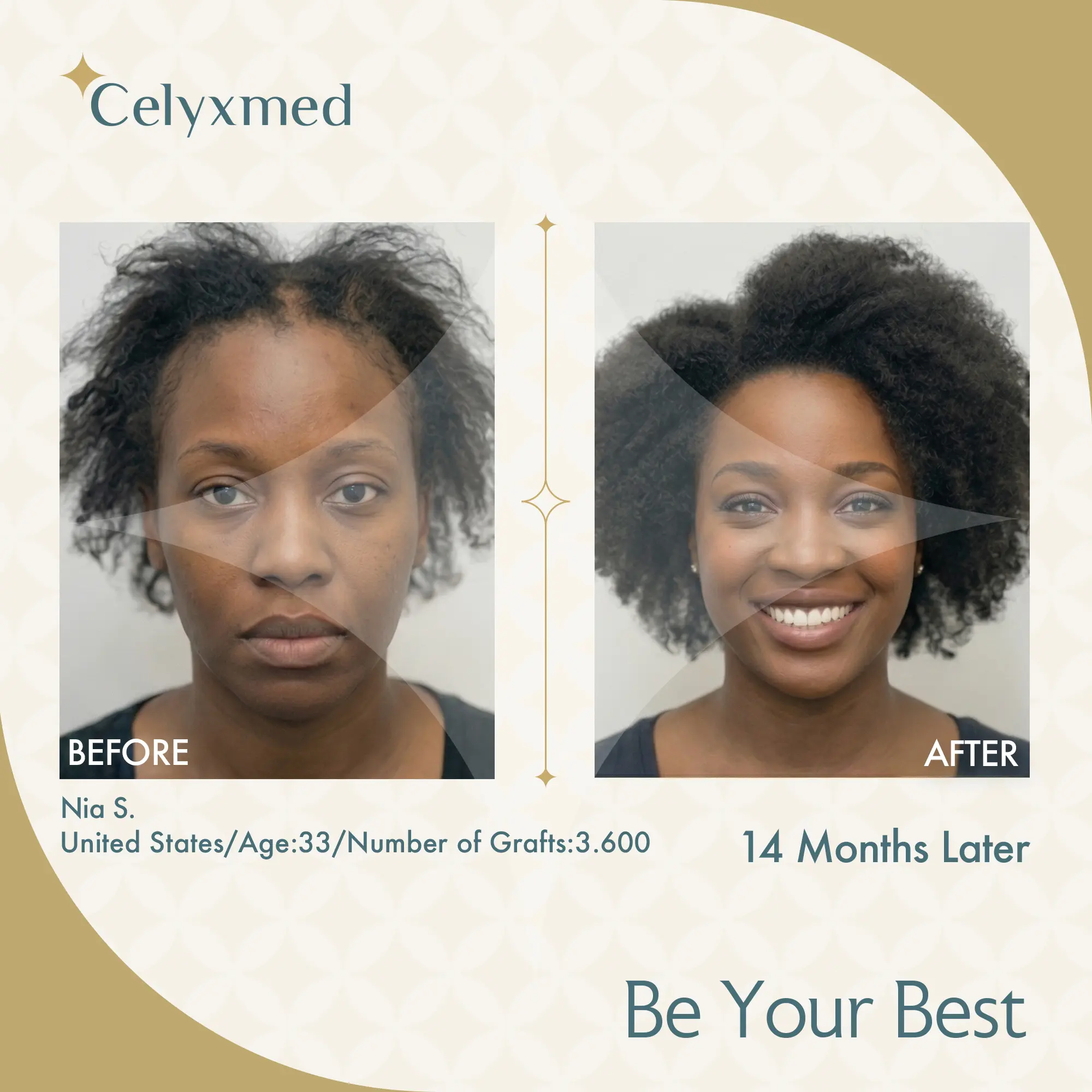 Afro Haartransplantation Türkei |