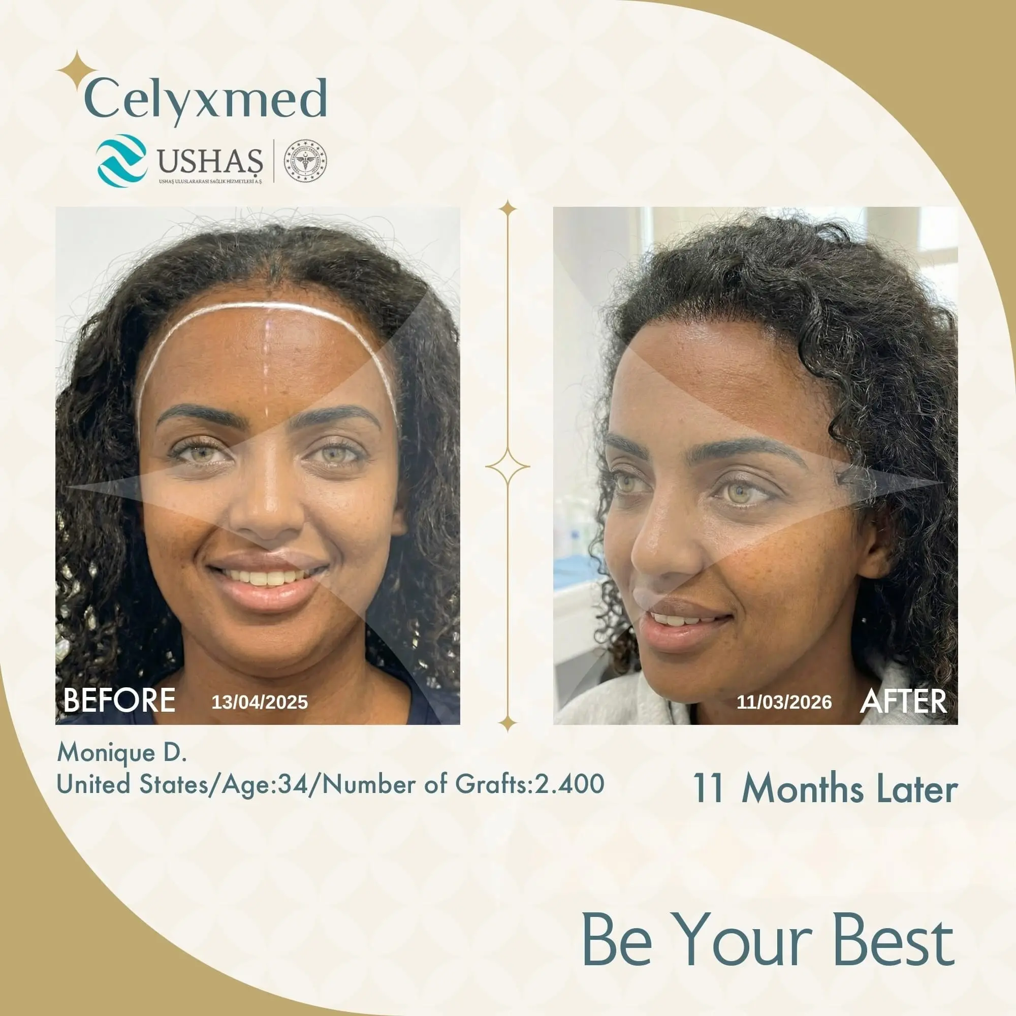 Afro Haartransplantation in der Türkei