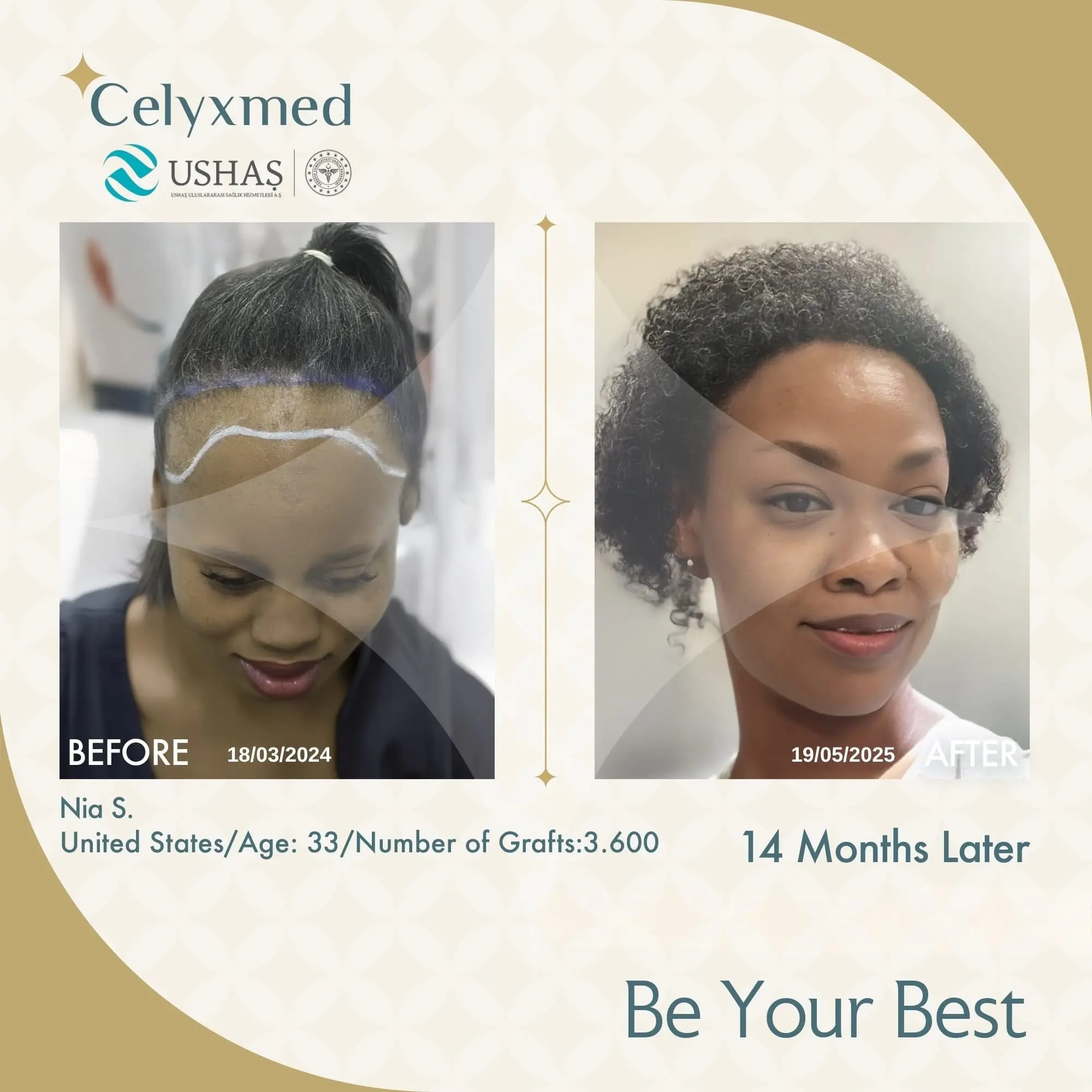 Afro Haartransplantation in der Türkei