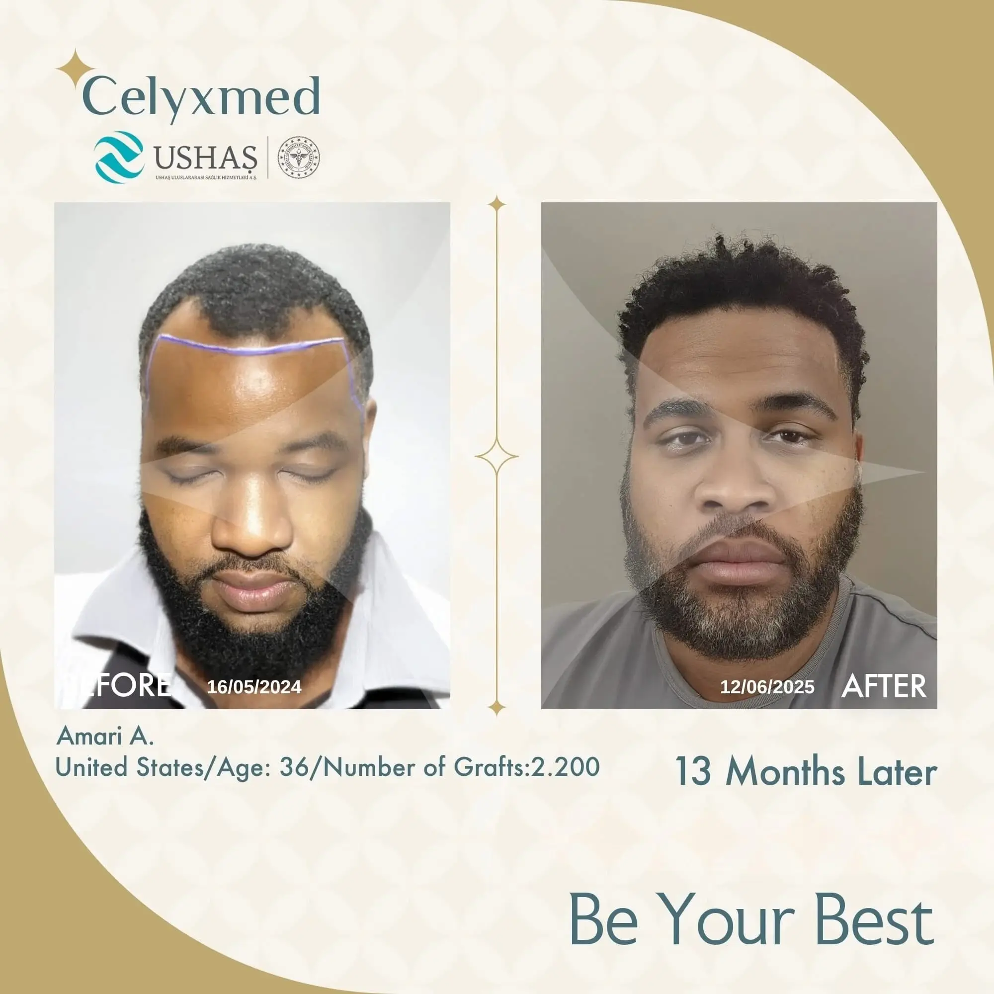 Afro Haartransplantation in der Türkei