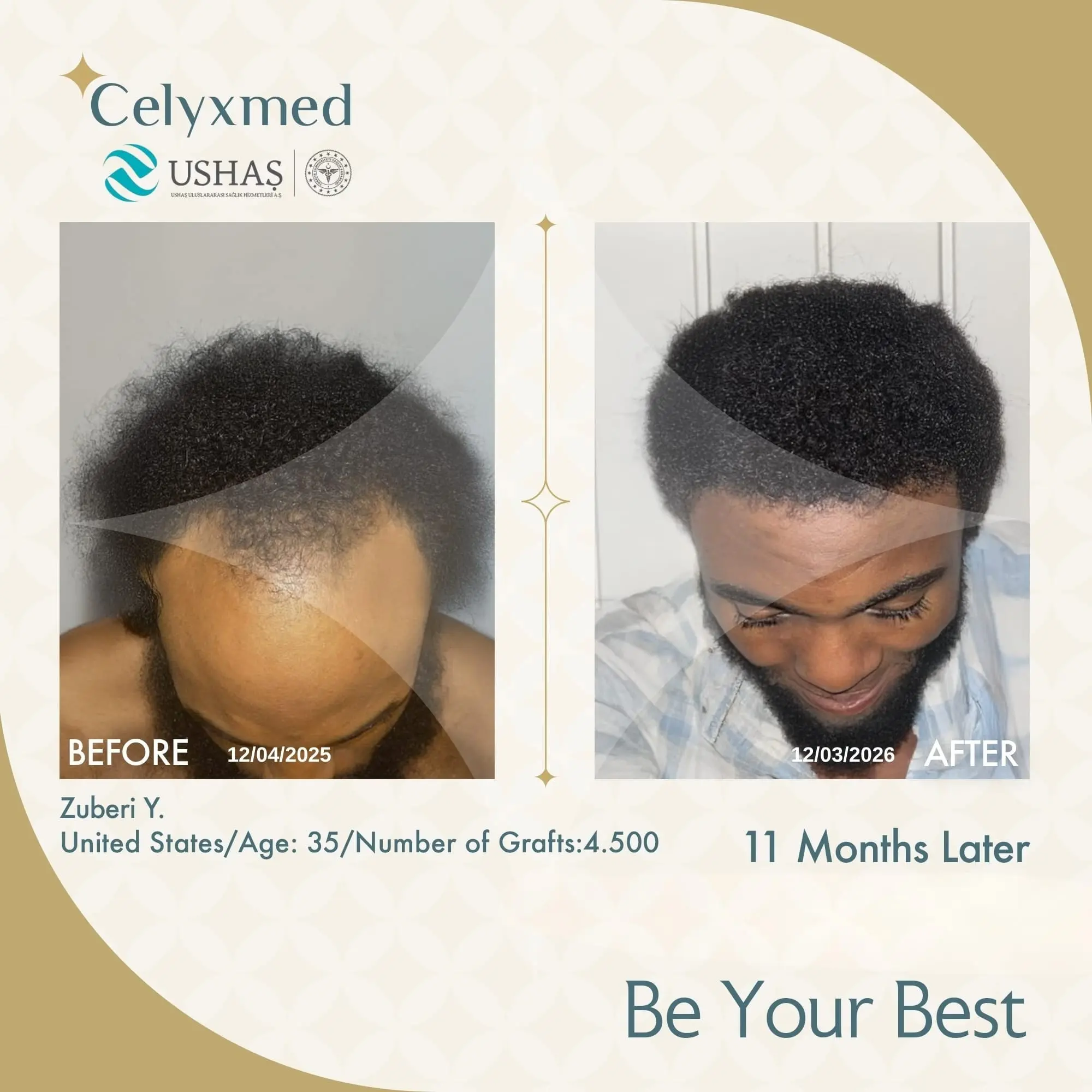 Afro Haartransplantation in der Türkei