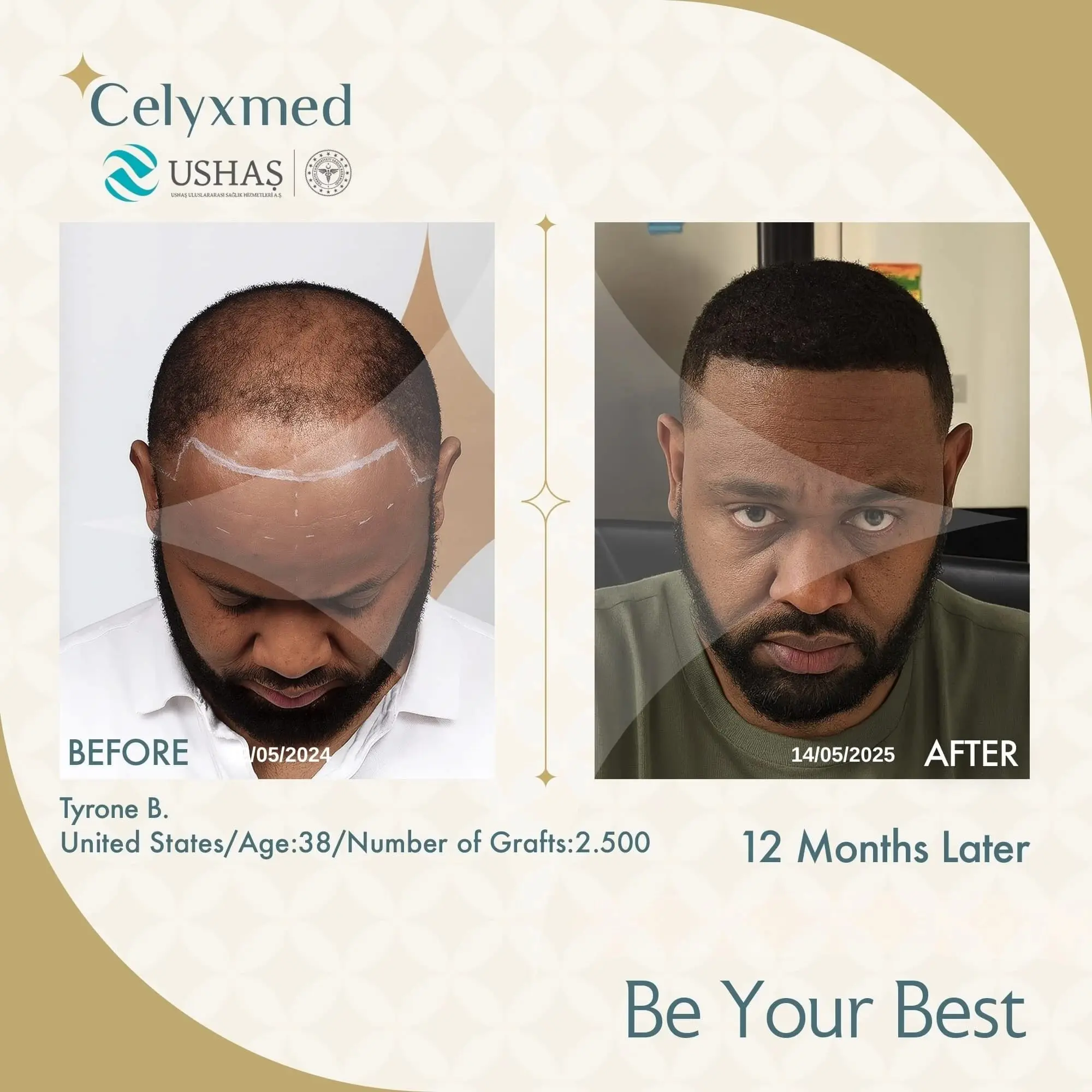 Afro Haartransplantation in der Türkei