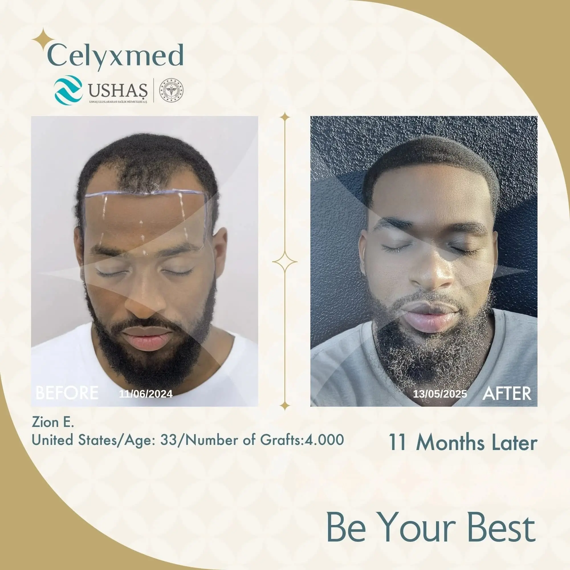 Afro Haartransplantation in der Türkei