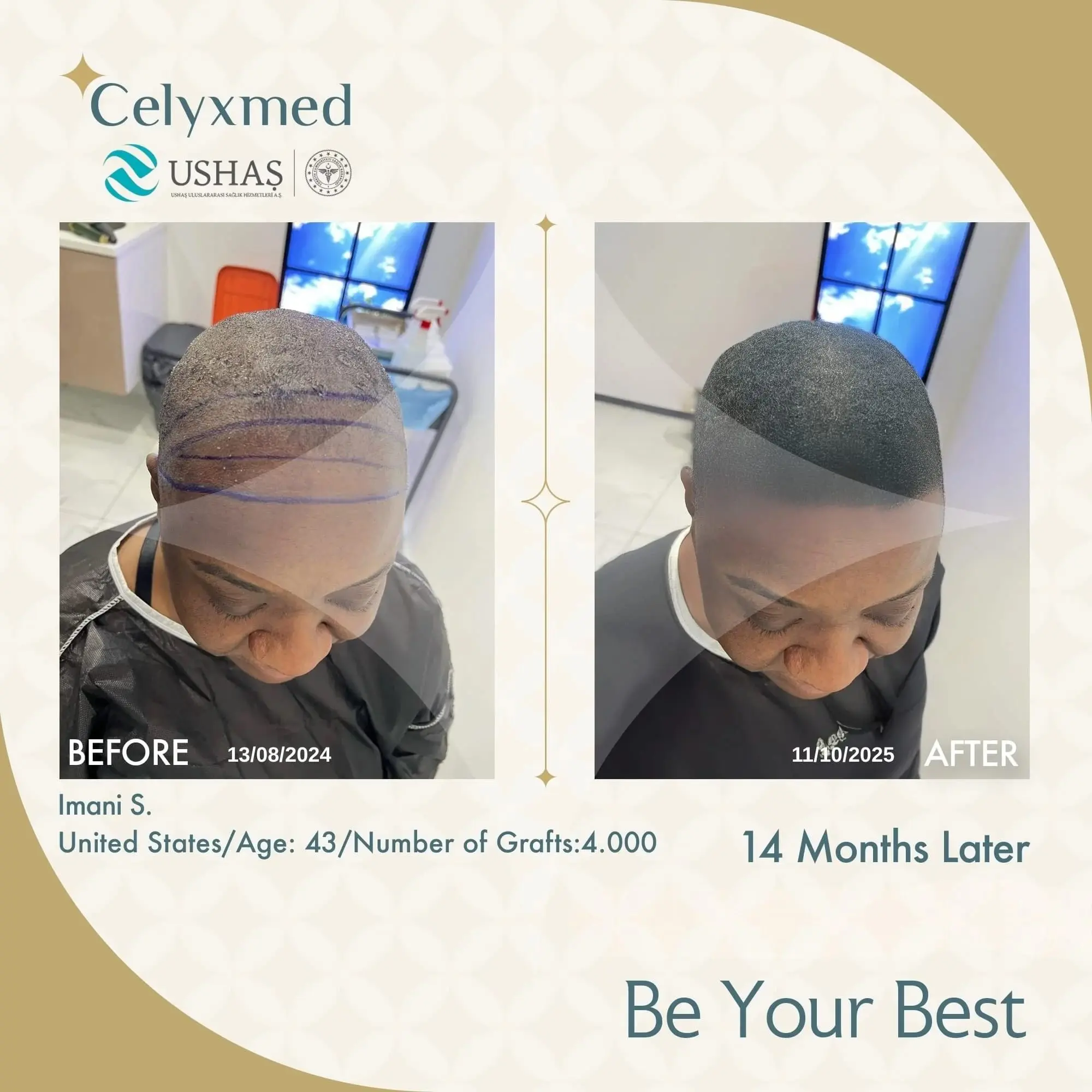 Afro Haartransplantation in der Türkei