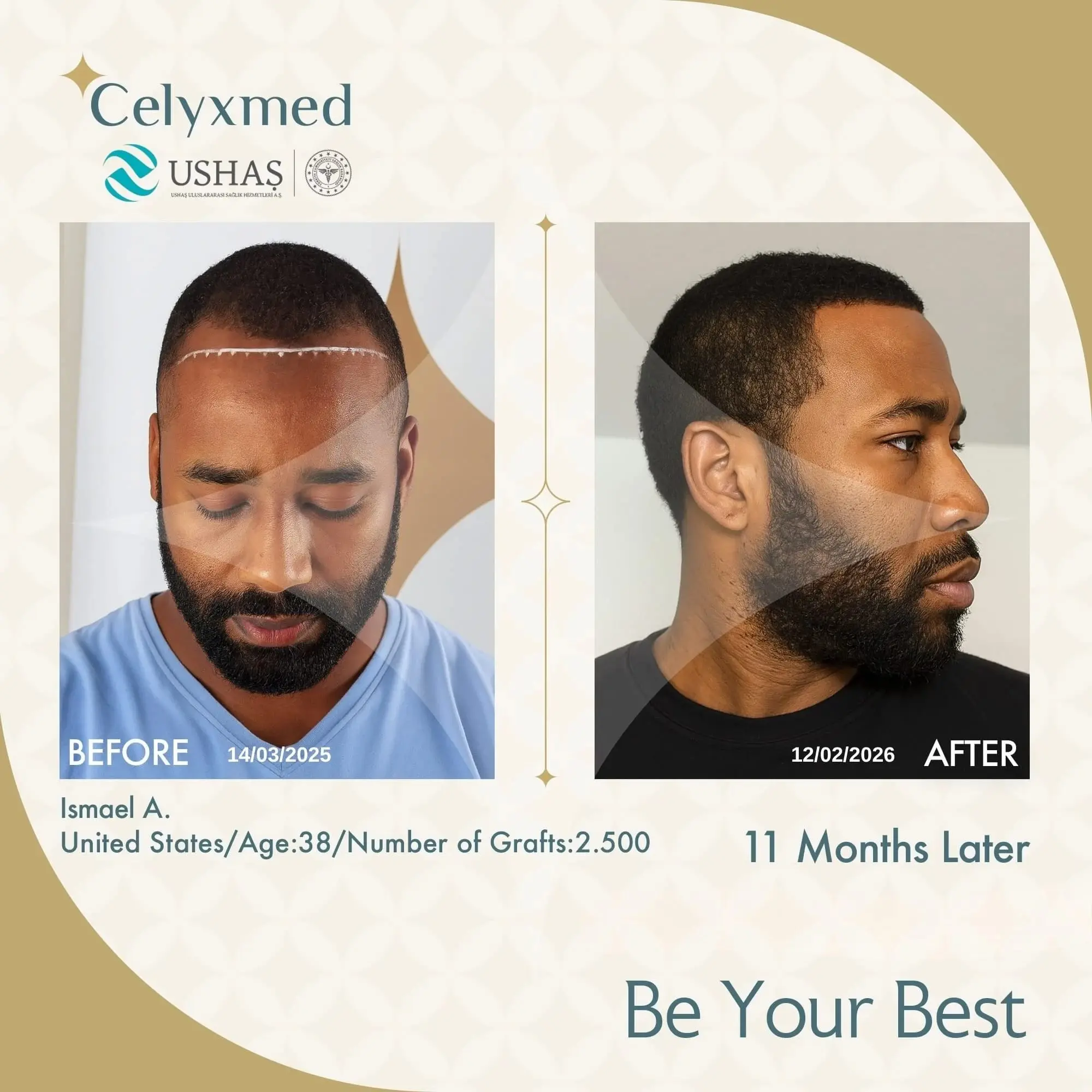 Afro Haartransplantation in der Türkei