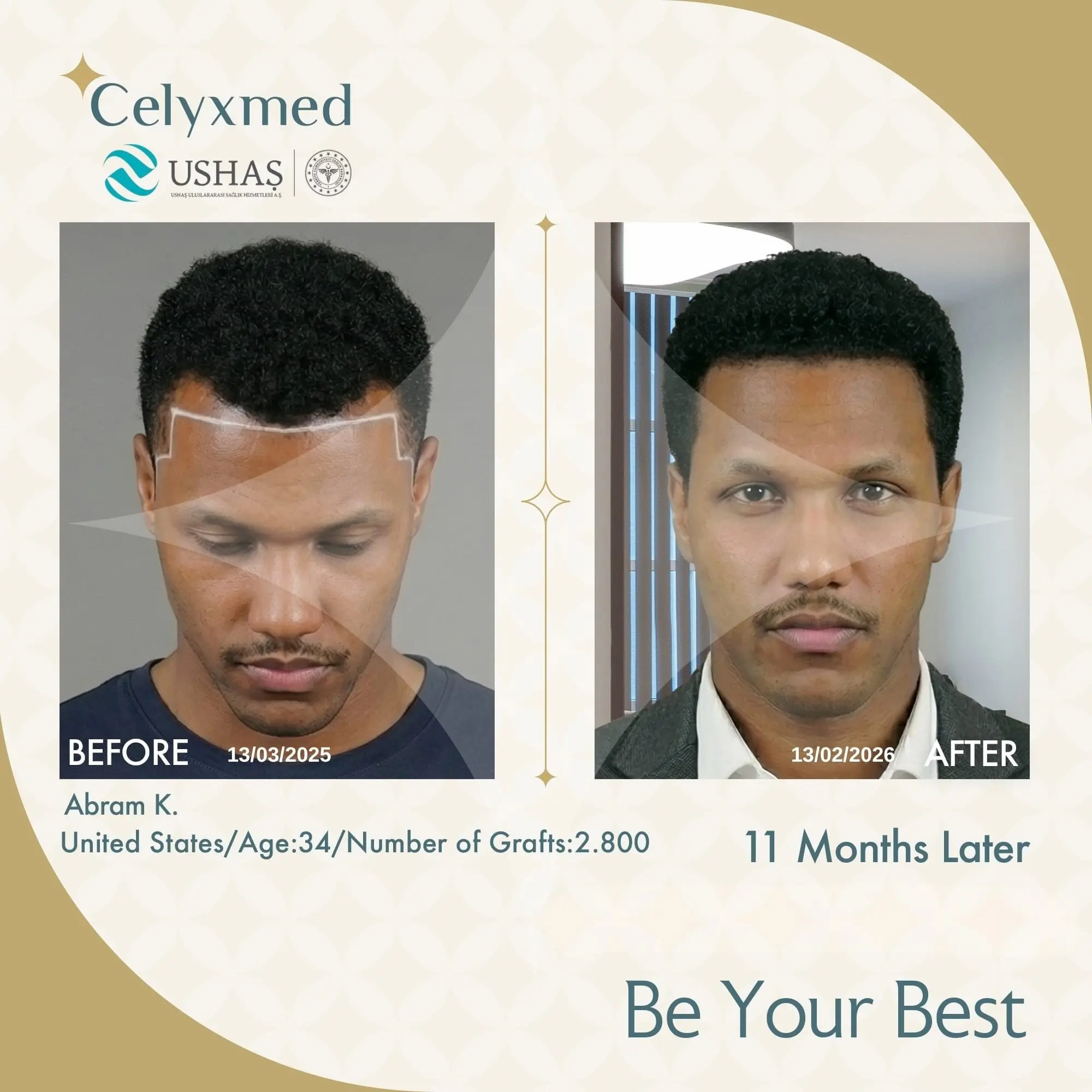 Afro Haartransplantation in der Türkei